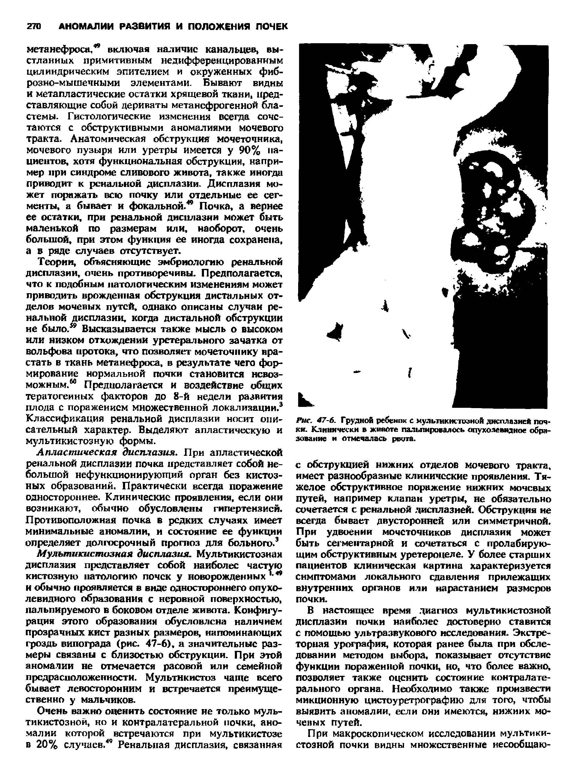 Рис. 47-6. Грудной ребенок с мультикиепганой дисплазией почки. Клинически в животе пальпировалось опухолевидное образование и отмечалась рвота.