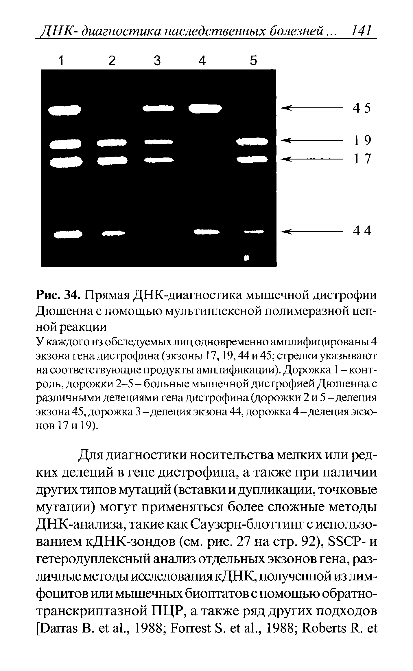 Рис. 34. Прямая ДНК-диагностика мышечной дистрофии Дюшенна с помощью мультиплексной полимеразной цепной реакции...