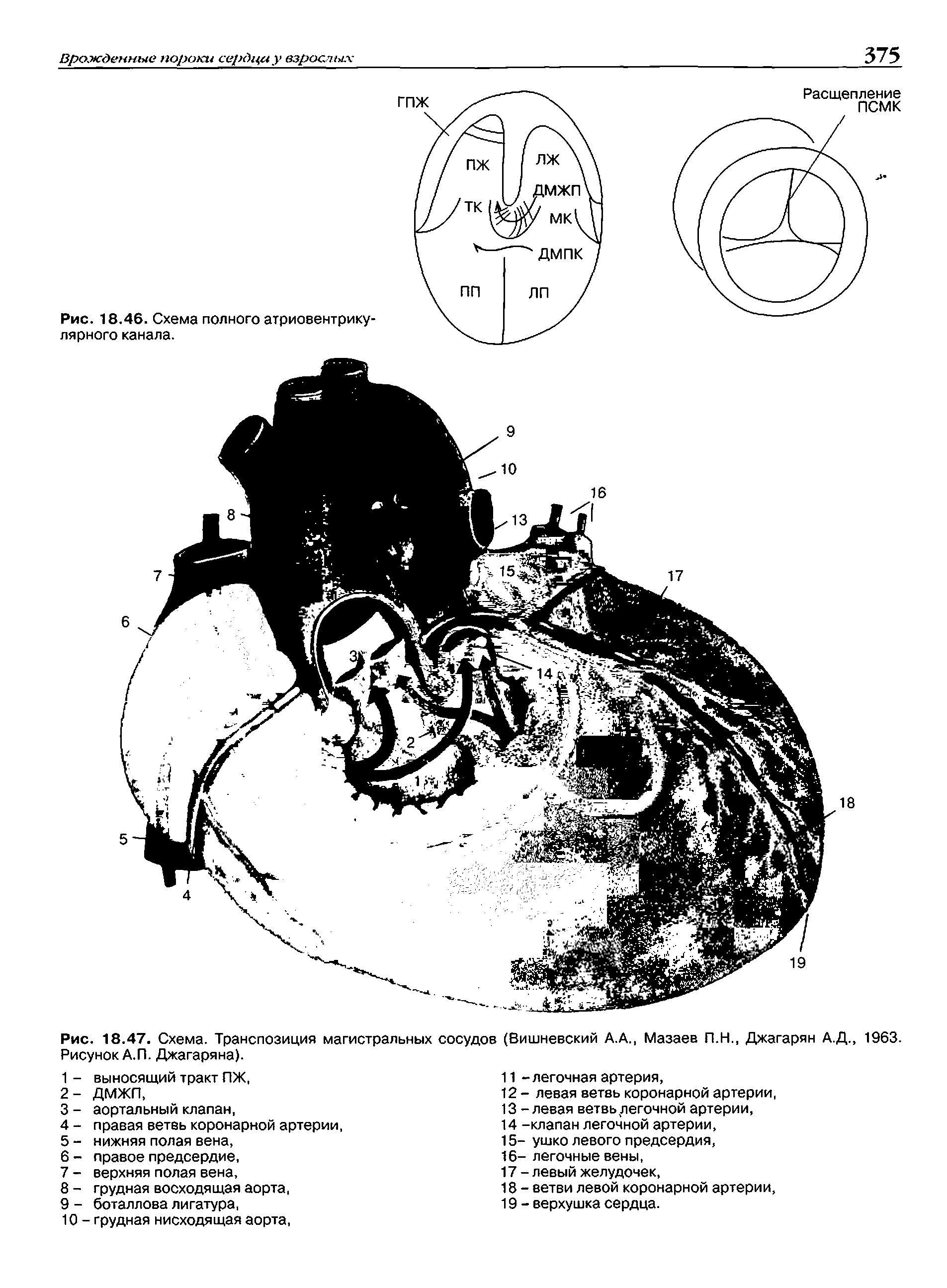 Рис. 18.47. Схема. Транспозиция магистральных сосудов (Вишневский А.А., Мазаев П.Н., Джагарян А.Д., 1963. Рисунок А.П. Джагаряна).