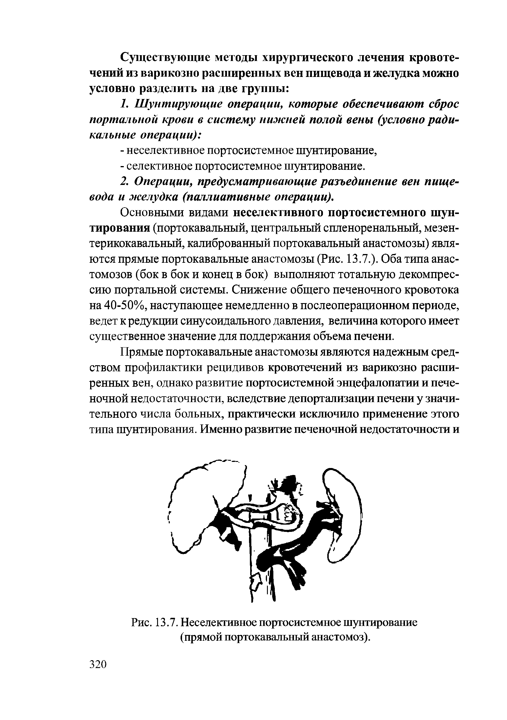 Рис. 13.7. Неселективное портосистемное шунтирование (прямой портокавальный анастомоз).