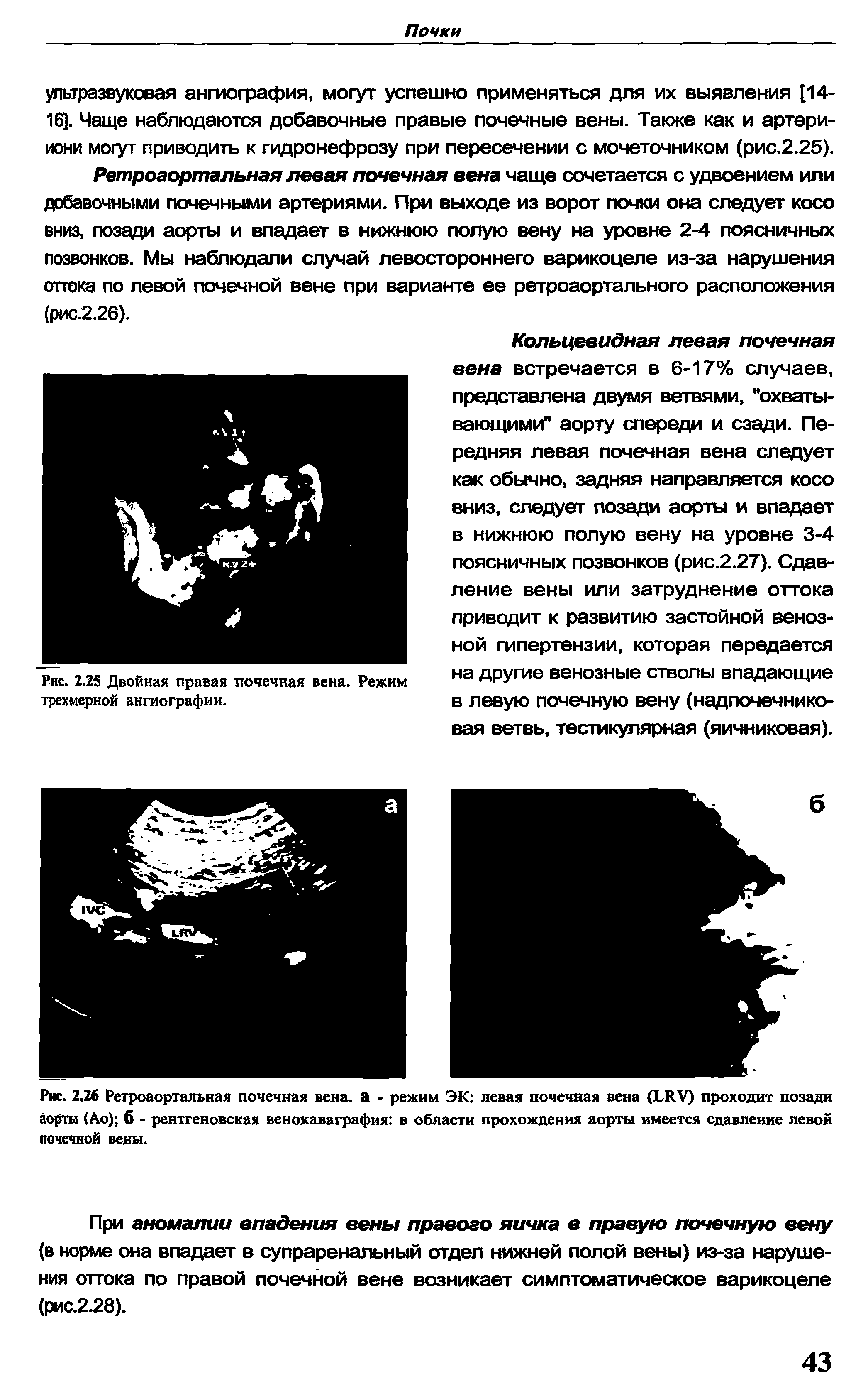 Рис. 2.26 Ретроаортальная почечная вена, а - режим ЭК левая почечная вена (ЬИУ) проходит позади Аорты (Ао) б - рентгеновская венокаваграфия в области прохождения аорты имеется сдавление левой почечной вены.