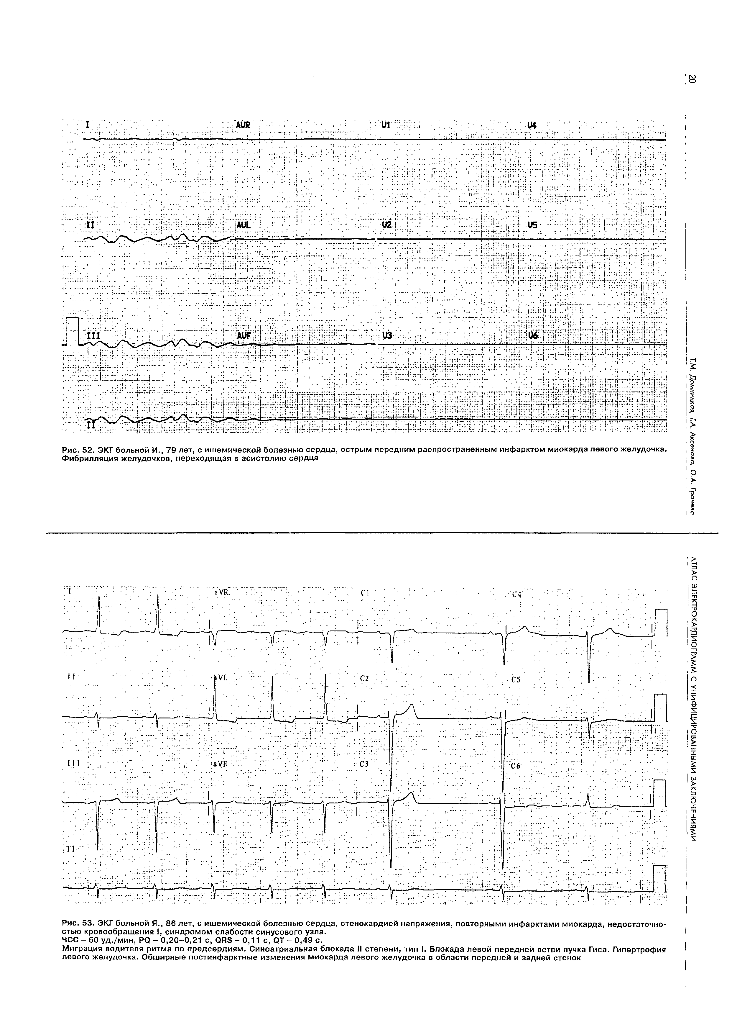 Рис. 53. ЭКГ больной Я., 86 лет, с ишемической болезнью сердца, стенокардией напряжения, повторными инфарктами миокарда, недостаточностью кровообращения I, синдромом слабости синусового узла.