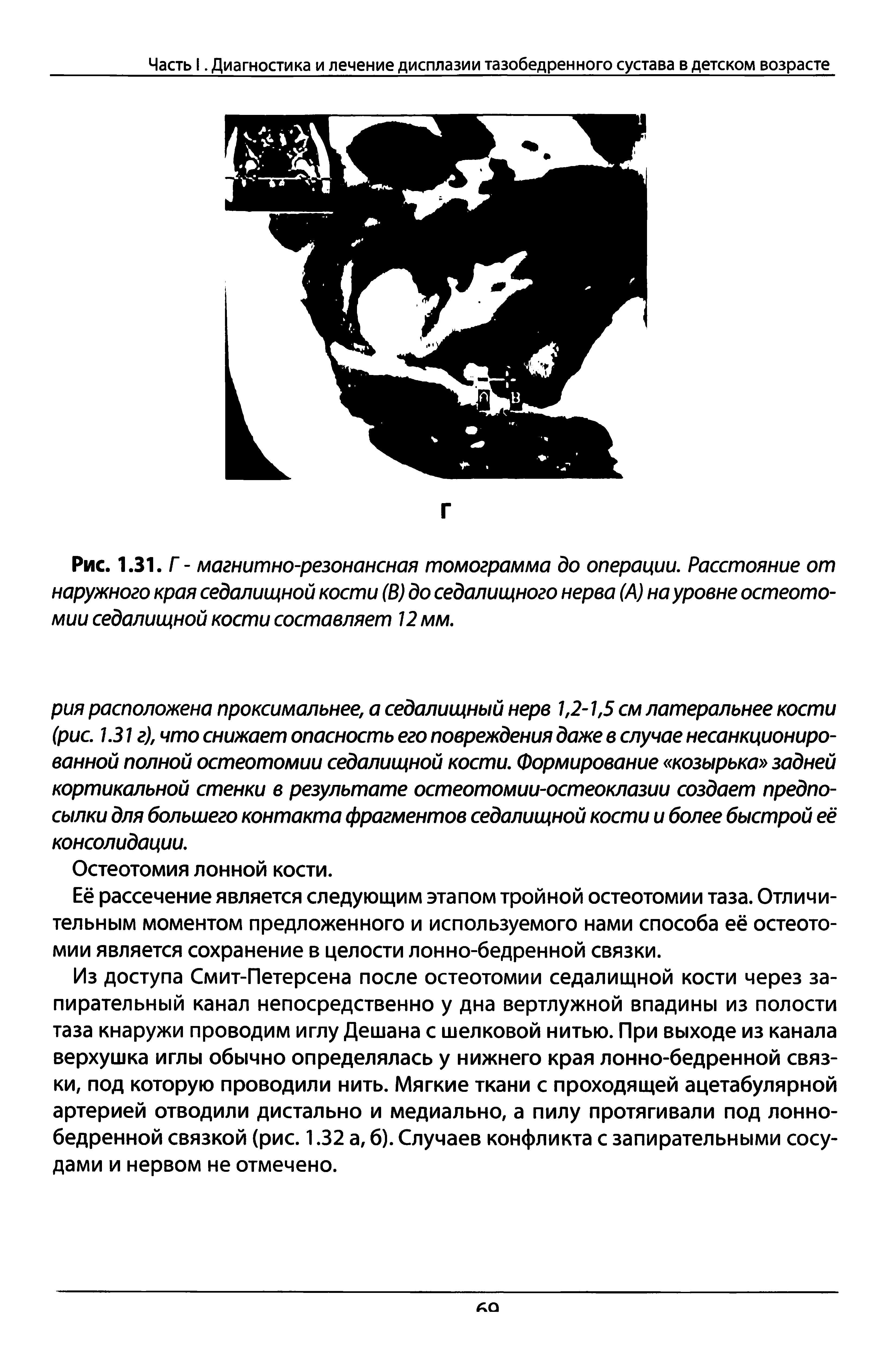 Рис. 1.31. Г - магнитно-резонансная томограмма до операции. Расстояние от наружного края седалищной кости (В) до седалищного нерва (А) на уровне остеотомии седалищной кости составляет 12 мм.