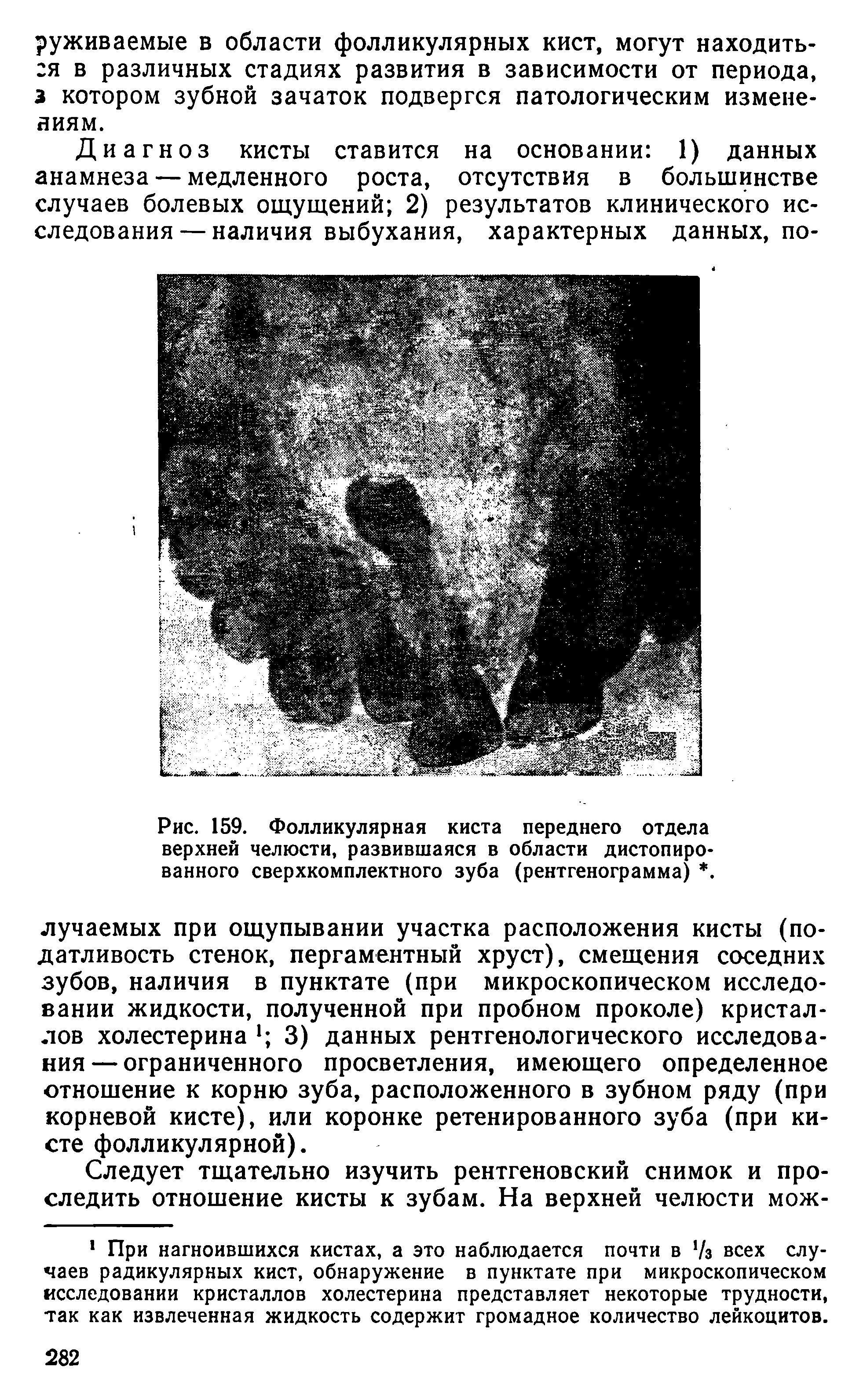 Рис. 159. Фолликулярная киста переднего отдела верхней челюсти, развившаяся в области дистопиро-ванного сверхкомплектного зуба (рентгенограмма). ...