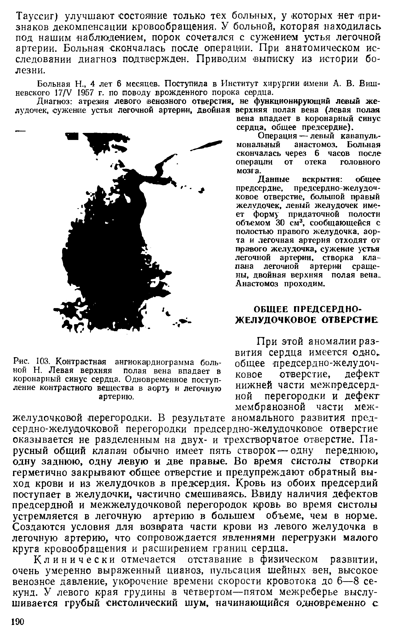 Рис. 103. Контрастная ангиока1рдиограмма больной Н. Левая верхняя полая вена впадает в коронарный синус сердца. Одновременное поступление контрастного вещества в аорту и легочную артерию.