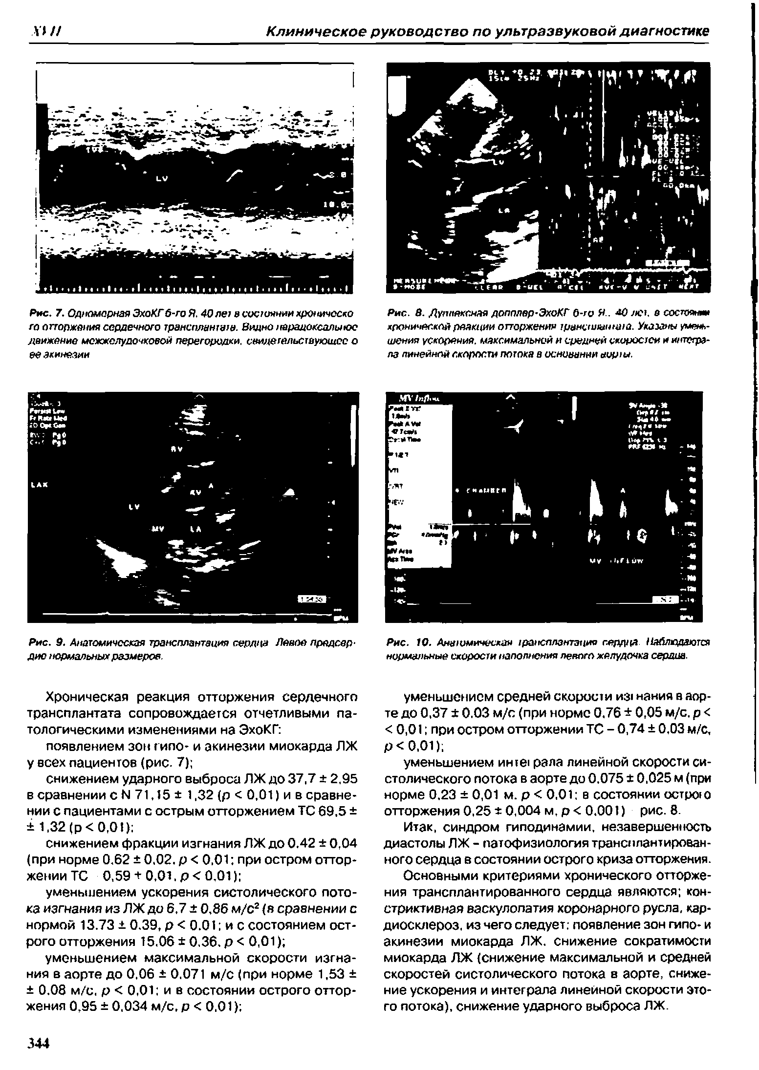 Рис. 10. Анатомическая трансплантация сердца Наблюдаются нормальные скорости наполнения левого желудочка сердив.