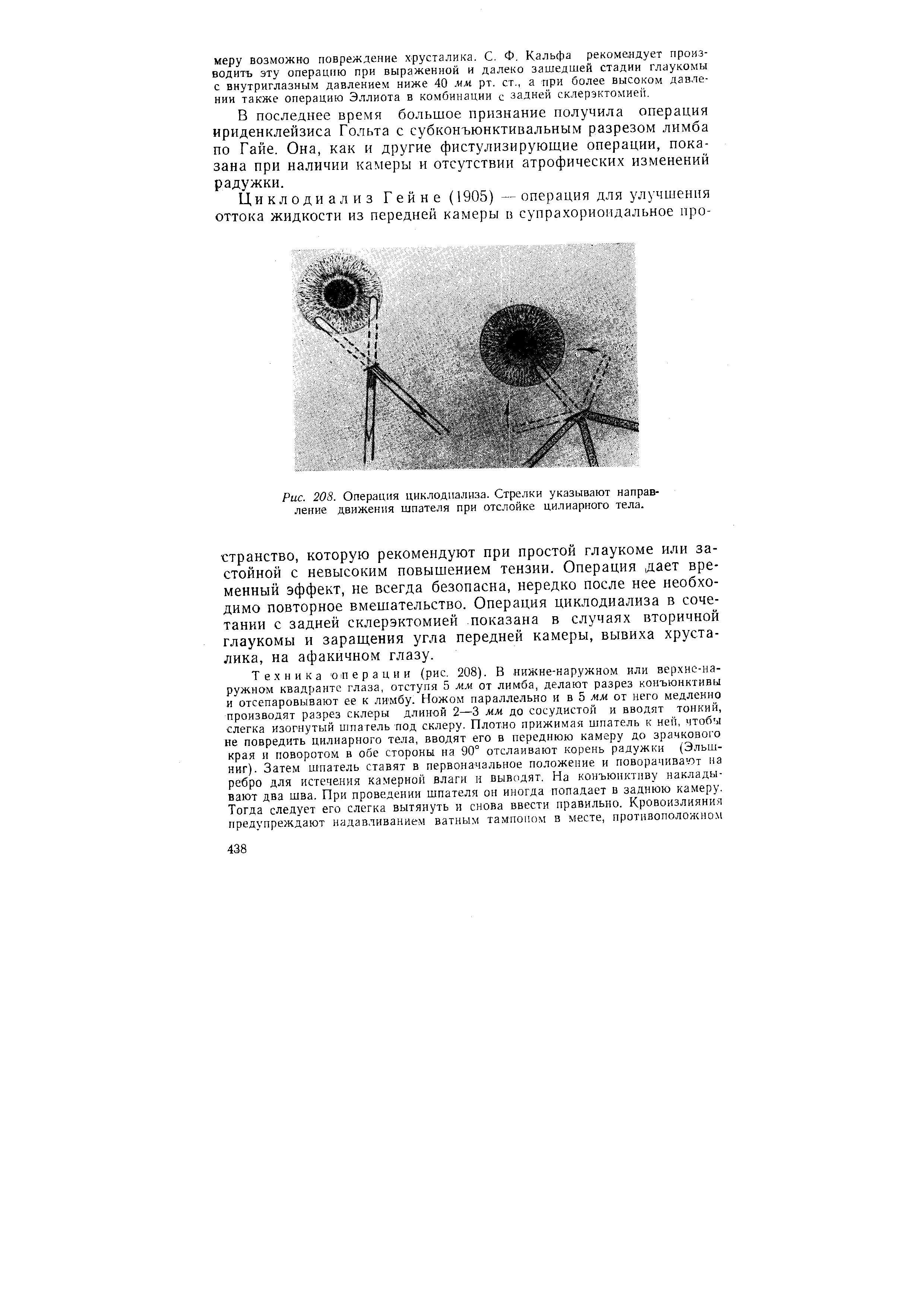 Рис. 208. Операция циклодпализа. Стрелки указывают направление движения шпателя при отслойке цилиарного тела.