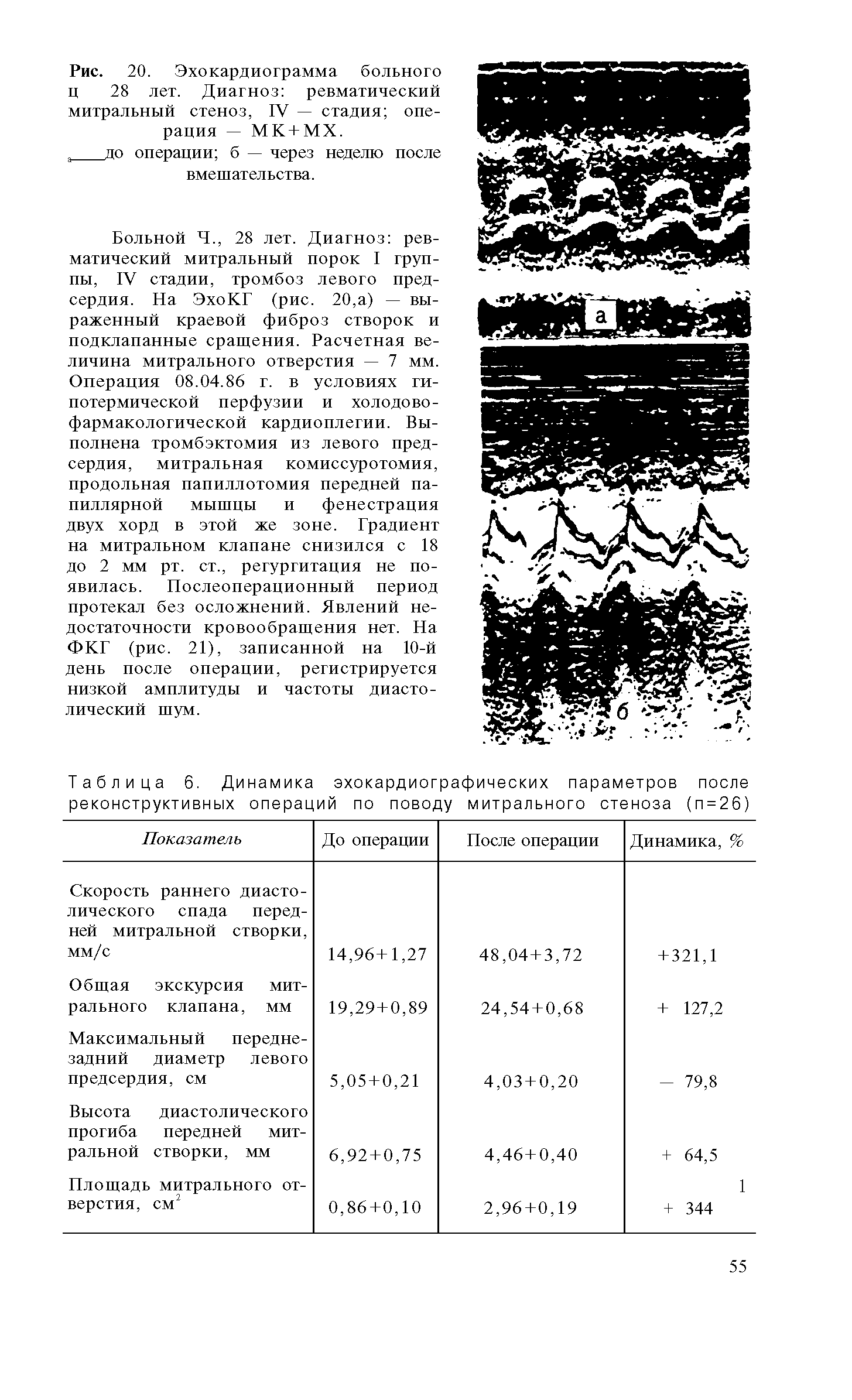 Таблица 6. Динамика эхокардиографических параметров после реконструктивных операций по поводу митрального стеноза (п=26)...