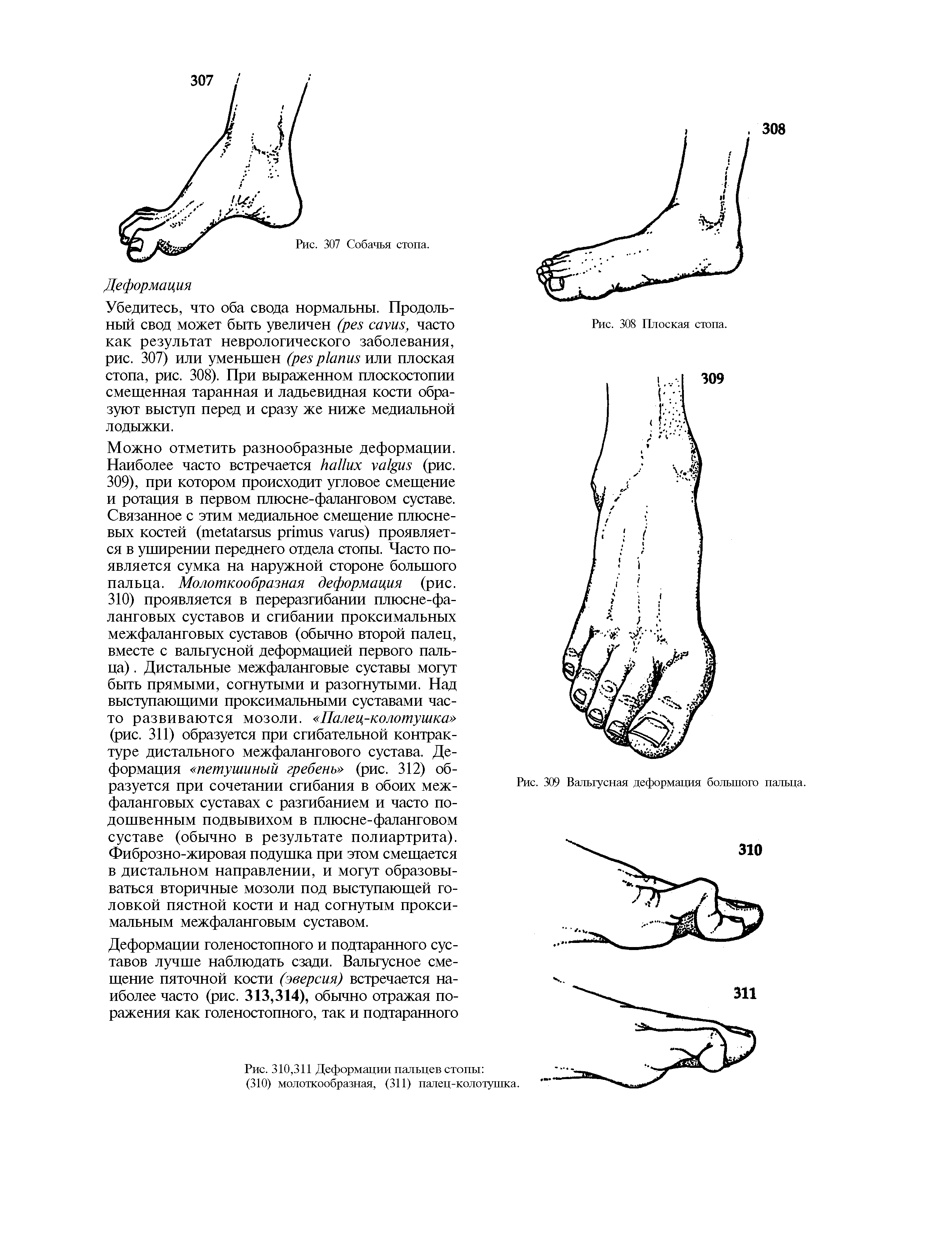Рис. 310,311 Деформации пальцев стопы (310) молоткообразная, (311) палец-колотушка.