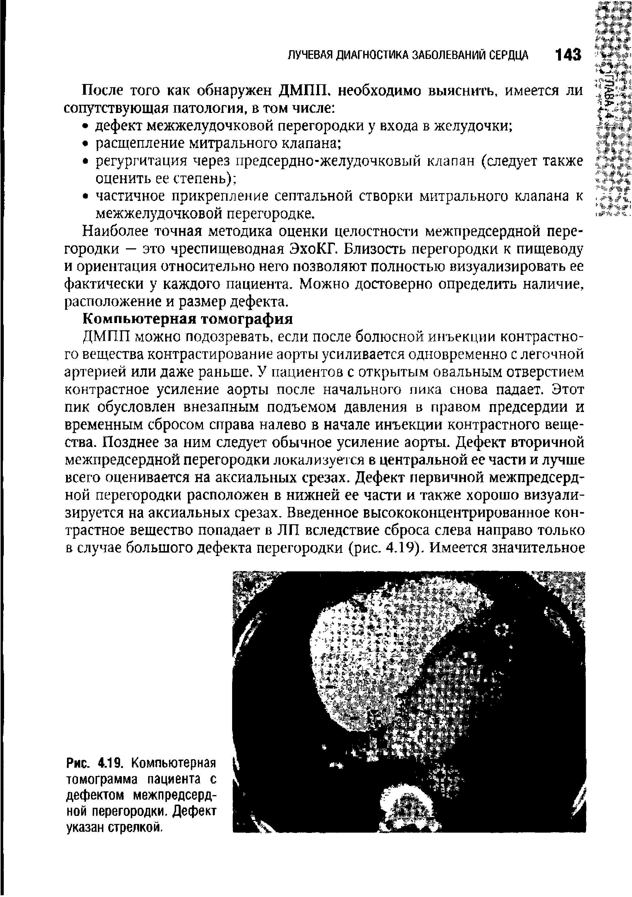 Рис. 4.19. Компьютерная томограмма пациента с дефектом межпредсердной перегородки. Дефект указан стрелкой.