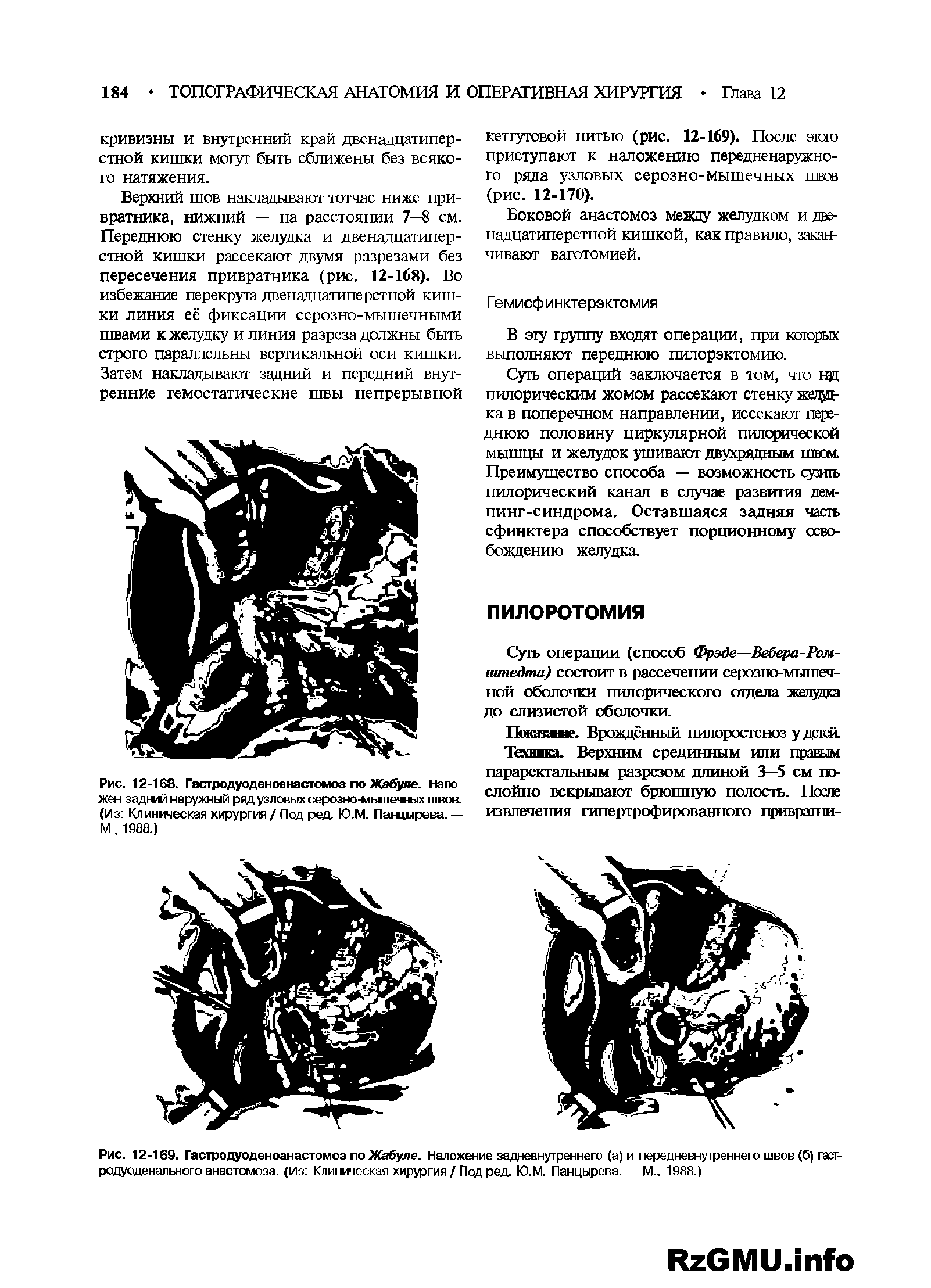 Рис. 12-169. Гастродуоденоанастомоз по Жабуле. Наложение задневнутреннего (а) и передневнутреннего швов (б) гастродуоденального анастомоза. (Из Клиническая хирургия / Под ред. Ю.М. Панцырева. — М.. 1988.)...