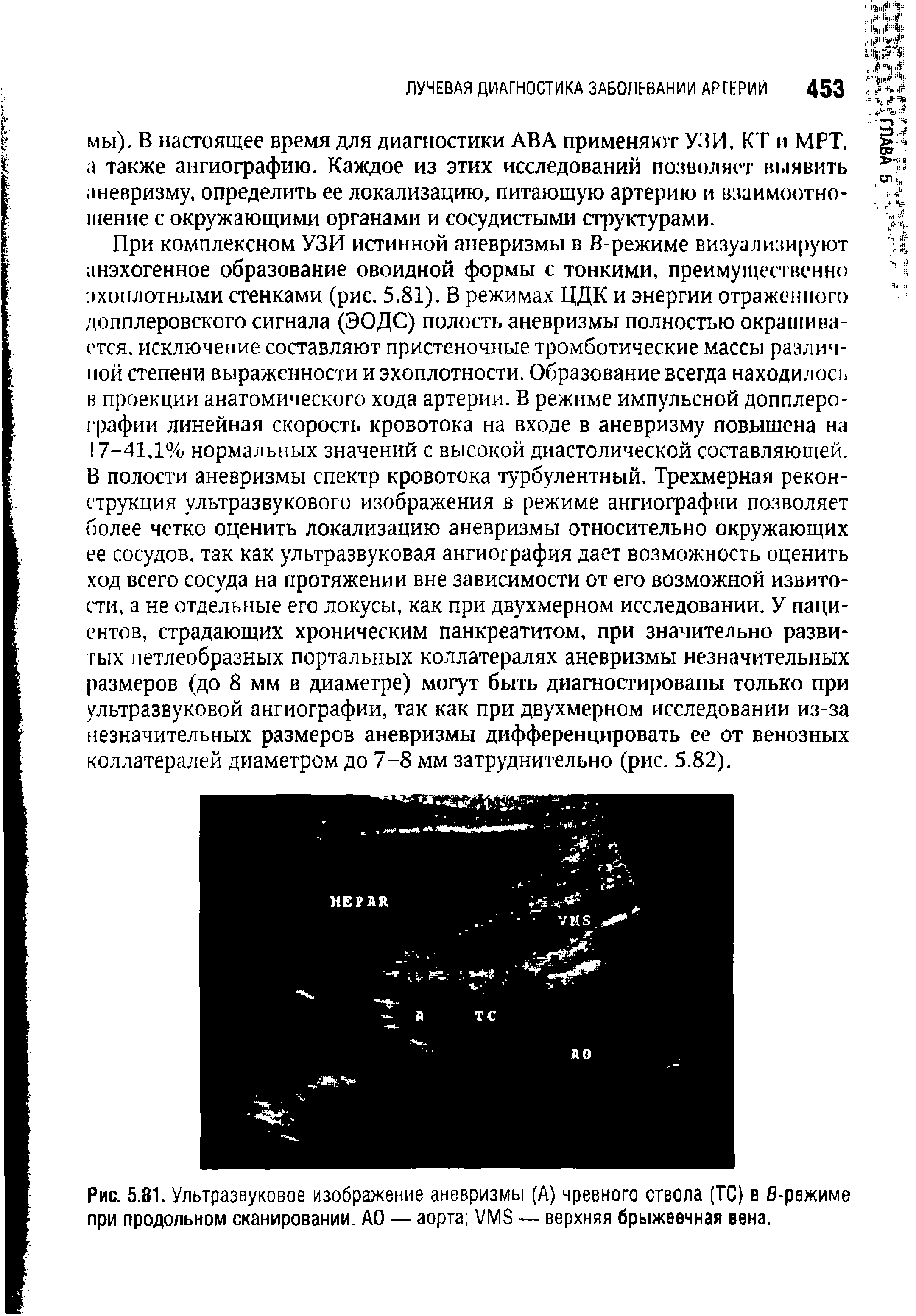 Рис. 5.81. Ультразвуковое изображение аневризмы (А) чревного ствола (ТС в б-режиме при продольном сканировании. АО — аорта УМБ — верхняя брыжеечная вена.