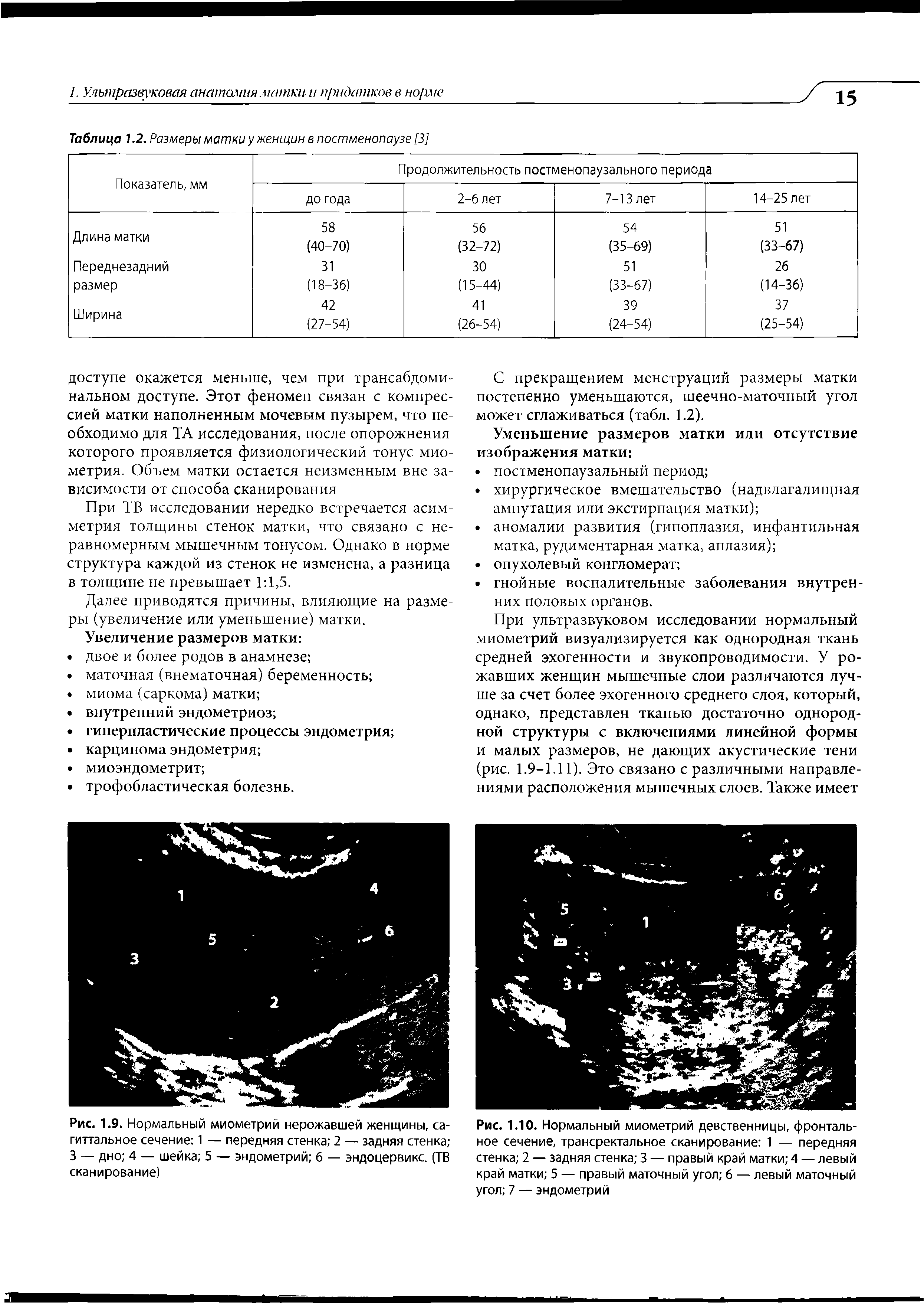 Рис. 1.9. Нормальный миометрий нерожавшей женщины, сагиттальное сечение 1 — передняя стенка 2 — задняя стенка 3 — дно 4 — шейка 5 — эндометрий б — эндоцервикс. (ТВ сканирование)...