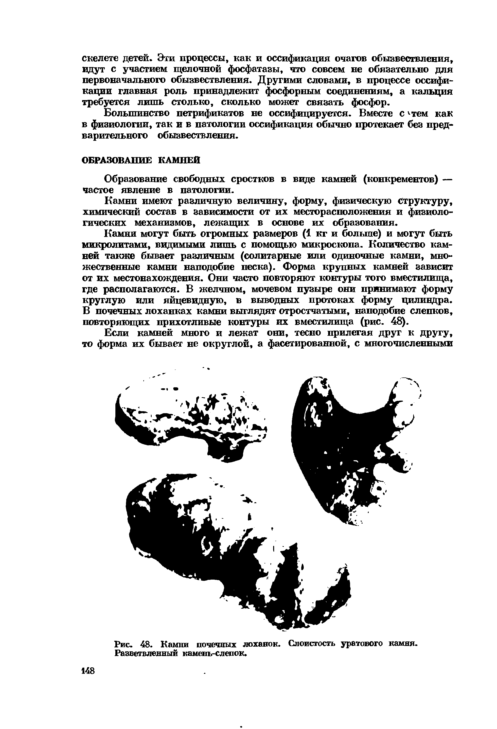 Рис. 48. Камни почечных лоханок. Слоистость уратового камня. Разветвленный камень-слепок.