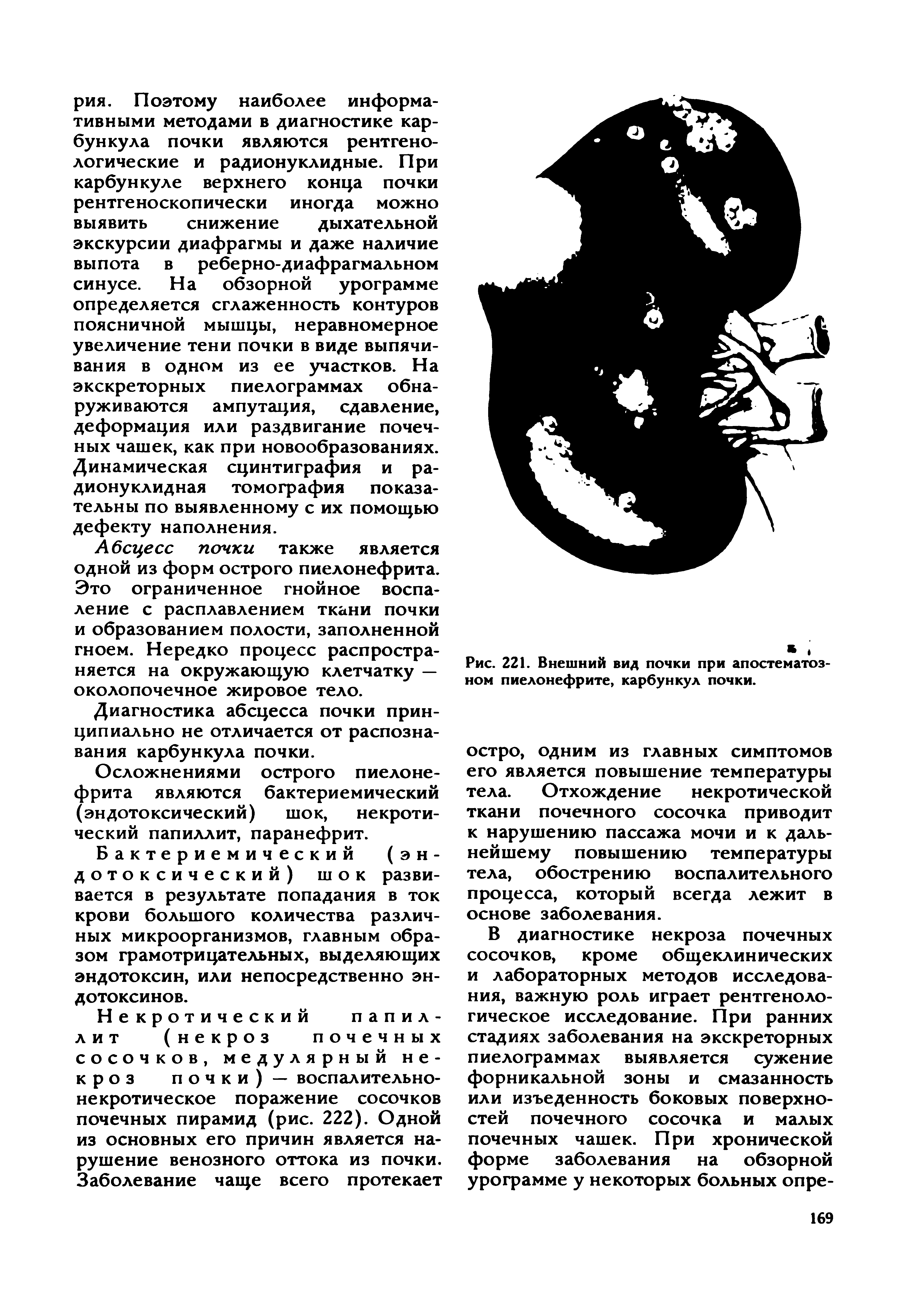 Рис. 221. Внешний вид почки при апостематозном пиелонефрите, карбункул почки.