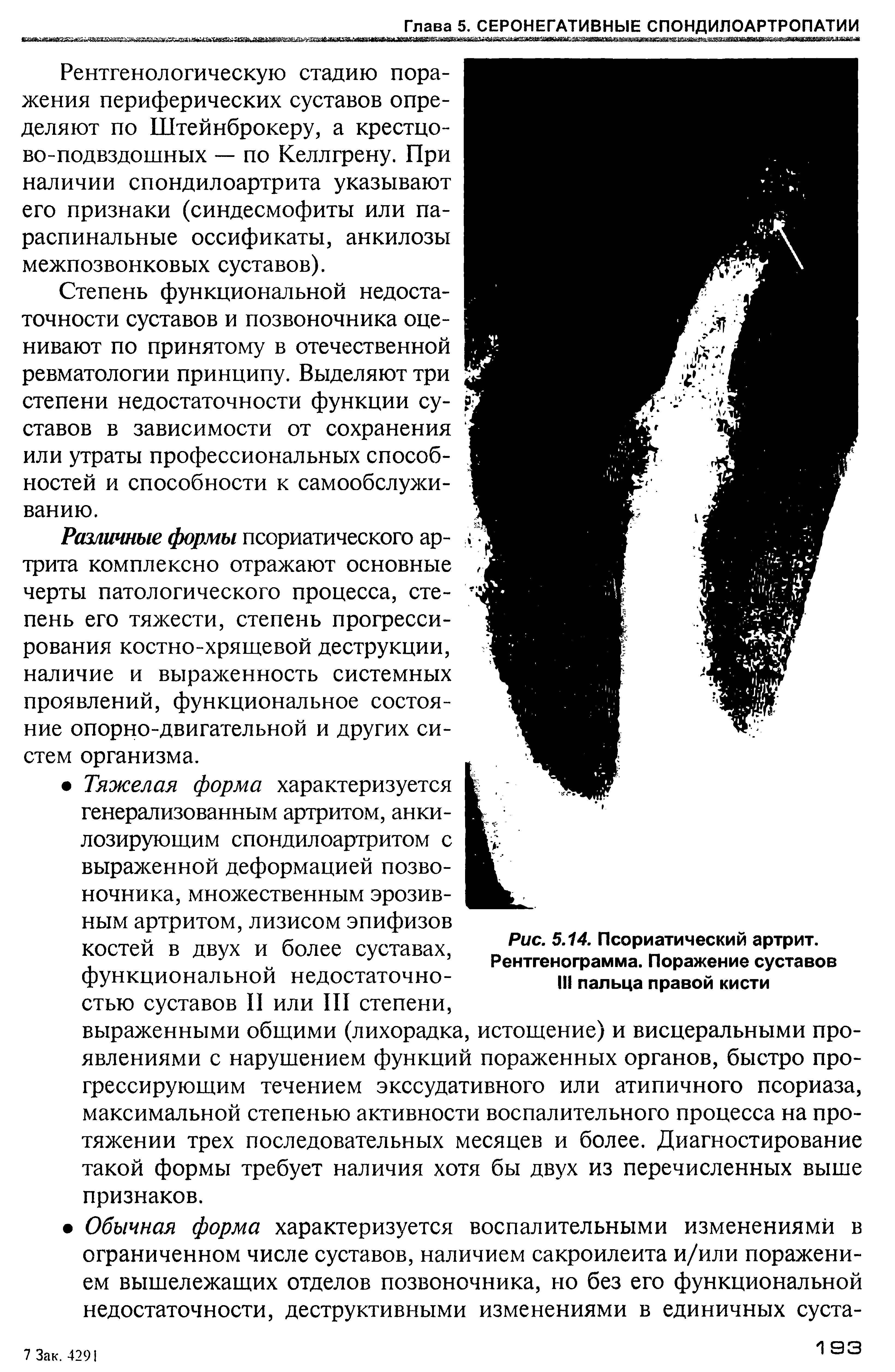 Рис. 5.14. Псориатический артрит. Рентгенограмма. Поражение суставов III пальца правой кисти...