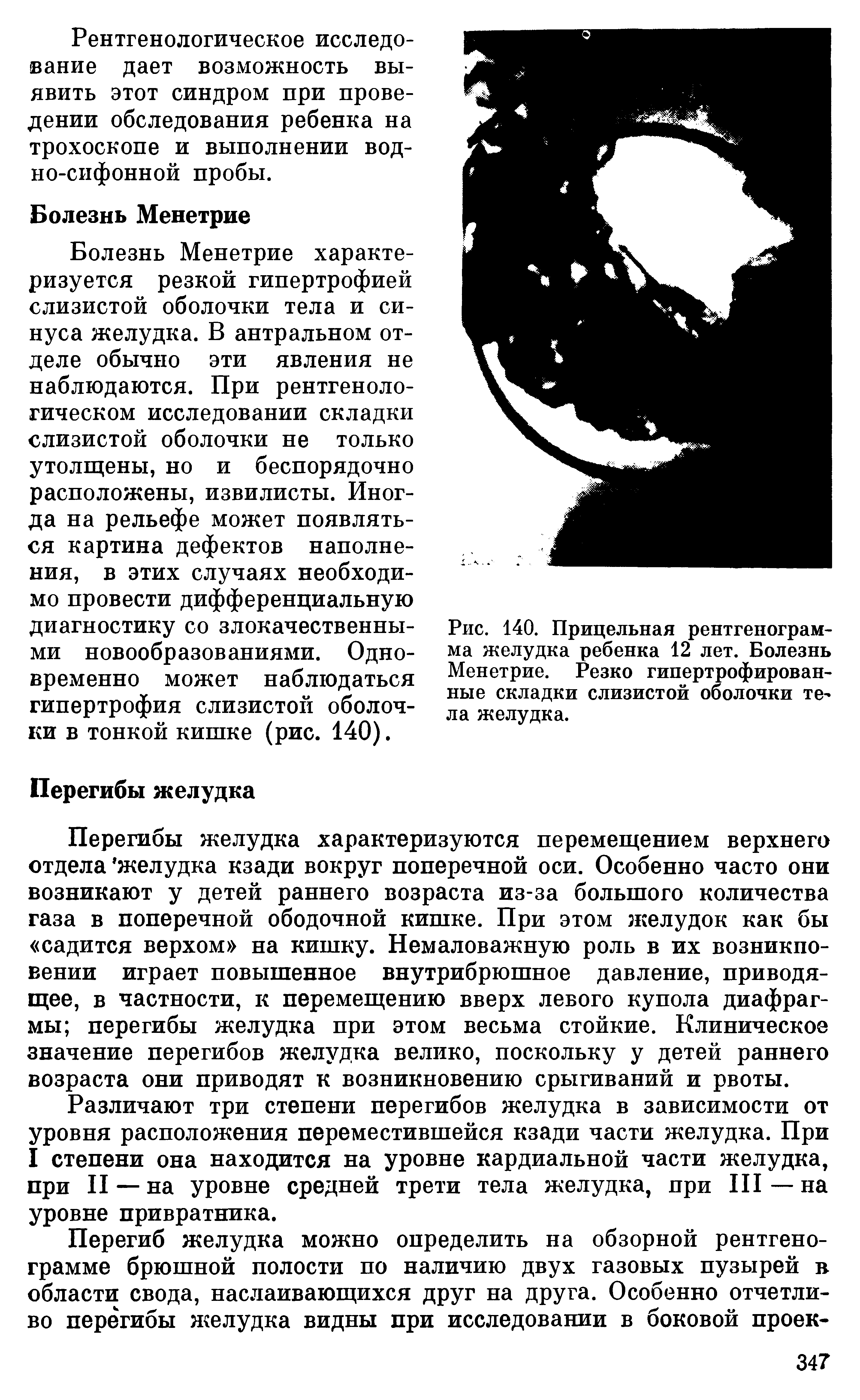 Рис. 140. Прицельная рентгенограмма желудка ребенка 12 лет. Болезнь Менетрие. Резко гипертрофированные складки слизистой оболочки те ла желудка.