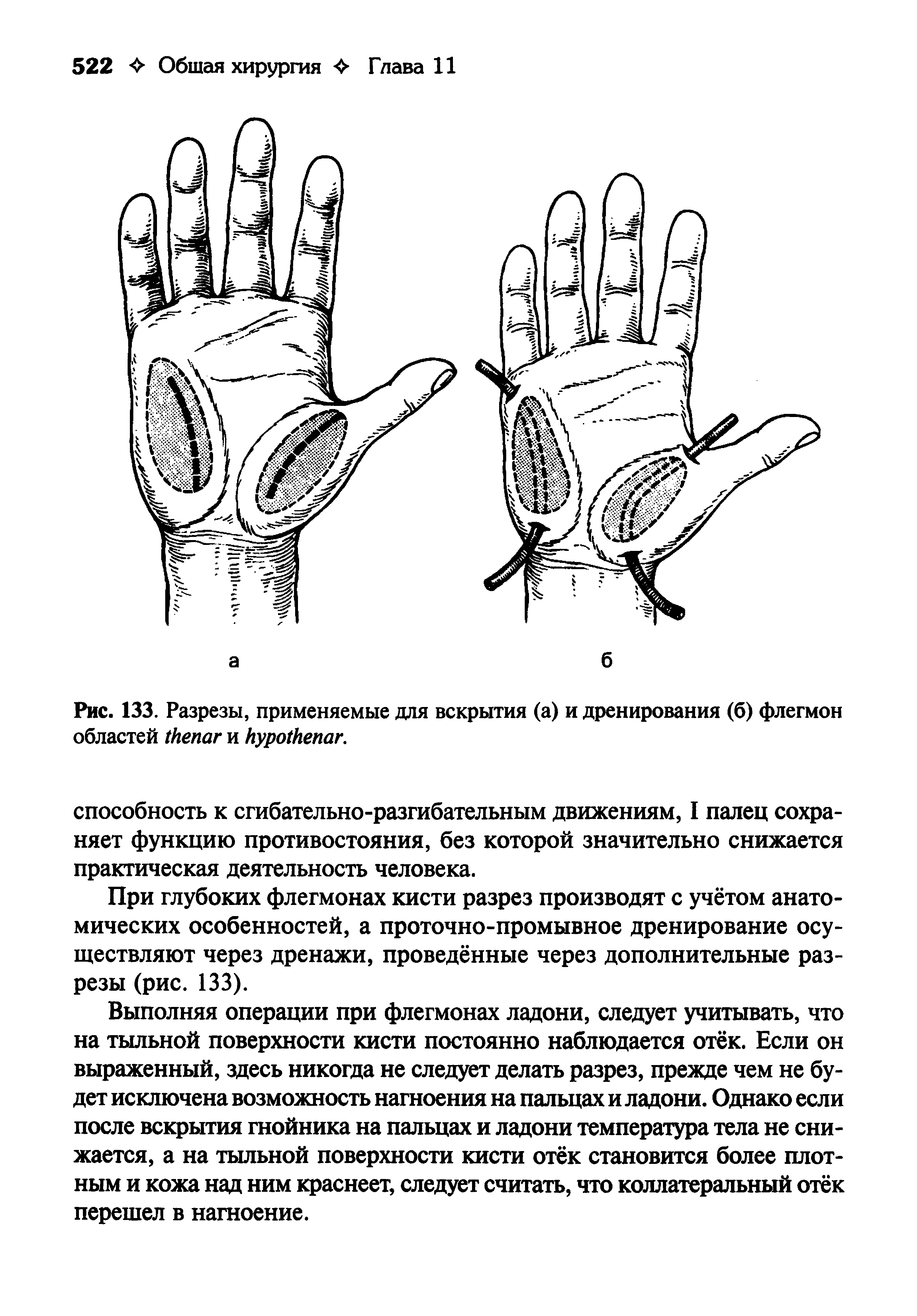 Рис. 133. Разрезы, применяемые для вскрытия (а) и дренирования (б) флегмон областей и .