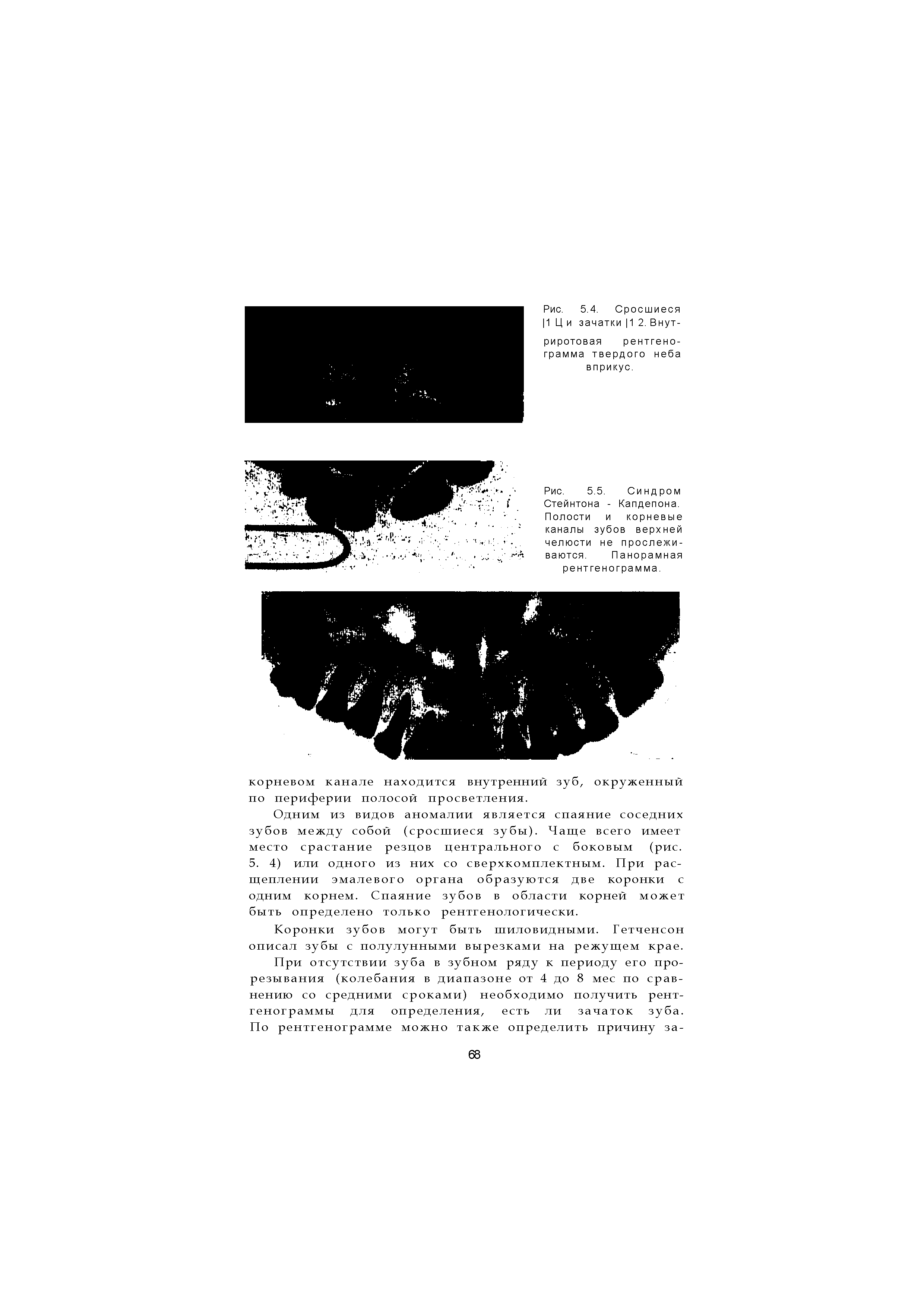 Рис. 5.5. Синдром Стейнтона - Капдепона. Полости и корневые каналы зубов верхней челюсти не прослеживаются. Панорамная рентгенограмма.