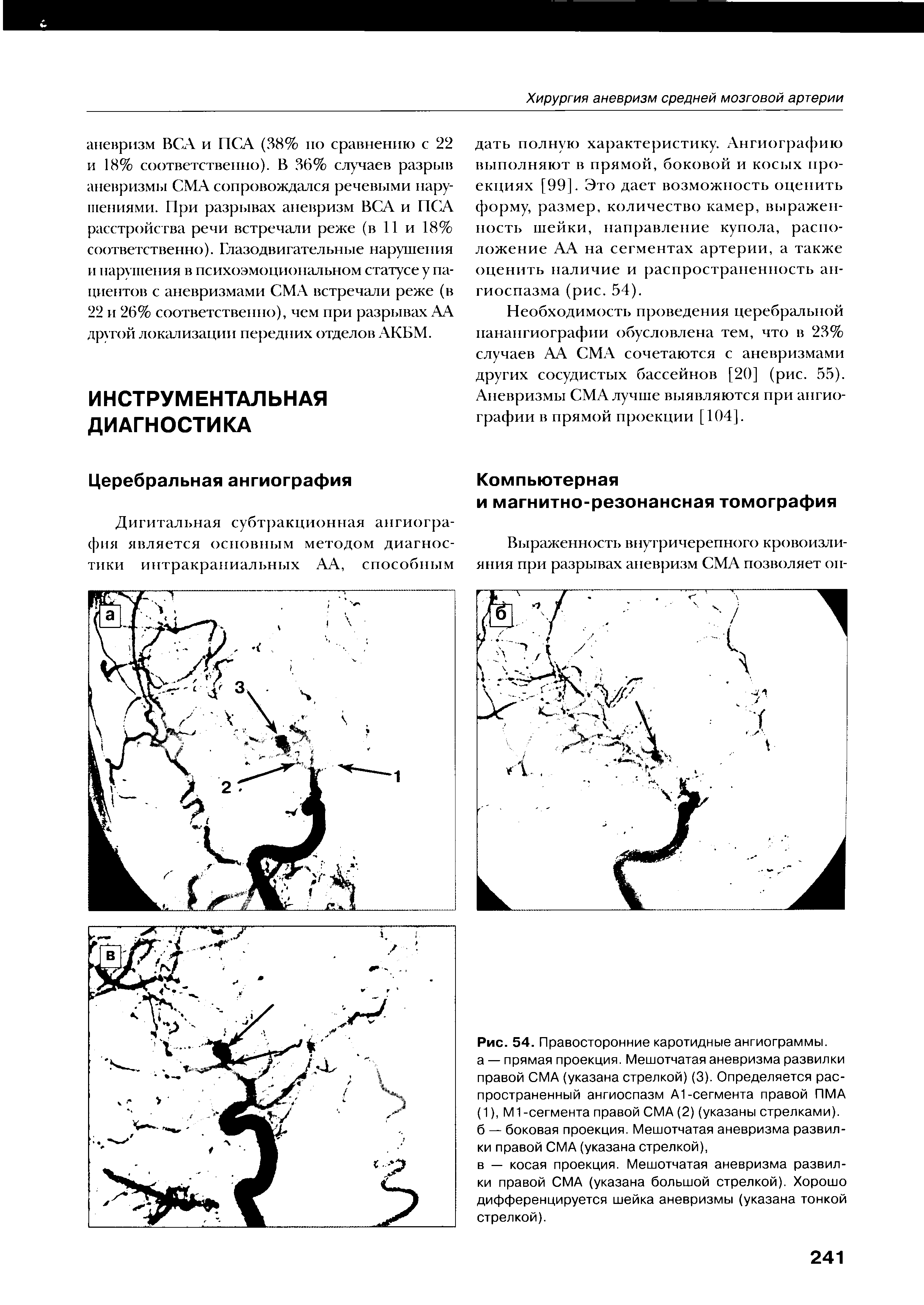 Рис. 54. Правосторонние каротидные ангиограммы, а — прямая проекция. Мешотчатая аневризма развилки правой СМА (указана стрелкой) (3). Определяется распространенный ангиоспазм А1-сегмента правой ПМА (1), М1 -сегмента правой СМА (2) (указаны стрелками), б — боковая проекция. Мешотчатая аневризма развилки правой СМА (указана стрелкой),...