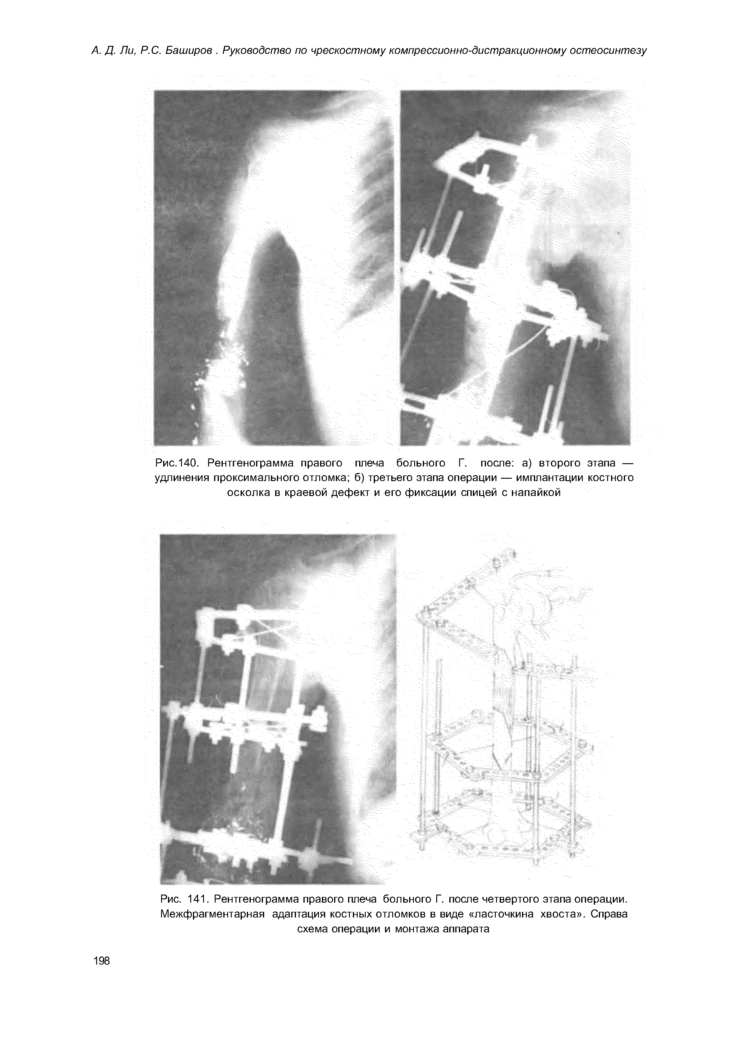 Рис. 141. Рентгенограмма правого плеча больного Г. после четвертого этапа операции. Межфрагментарная адаптация костных отломков в виде ласточкина хвоста . Справа схема операции и монтажа аппарата...
