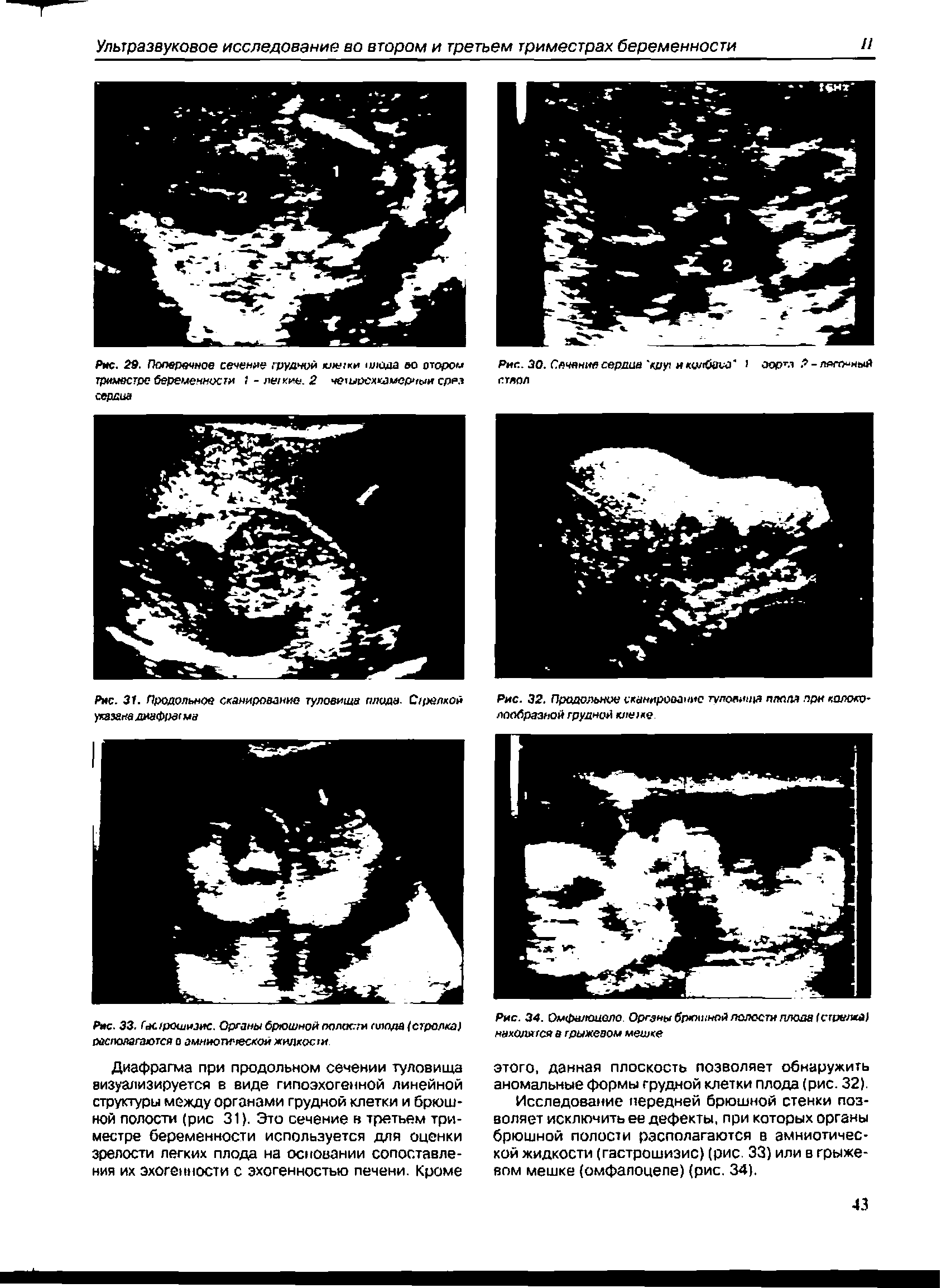 Рис. 34. Омфилоиоло. Органы брюшной полости плода (стрелка)...