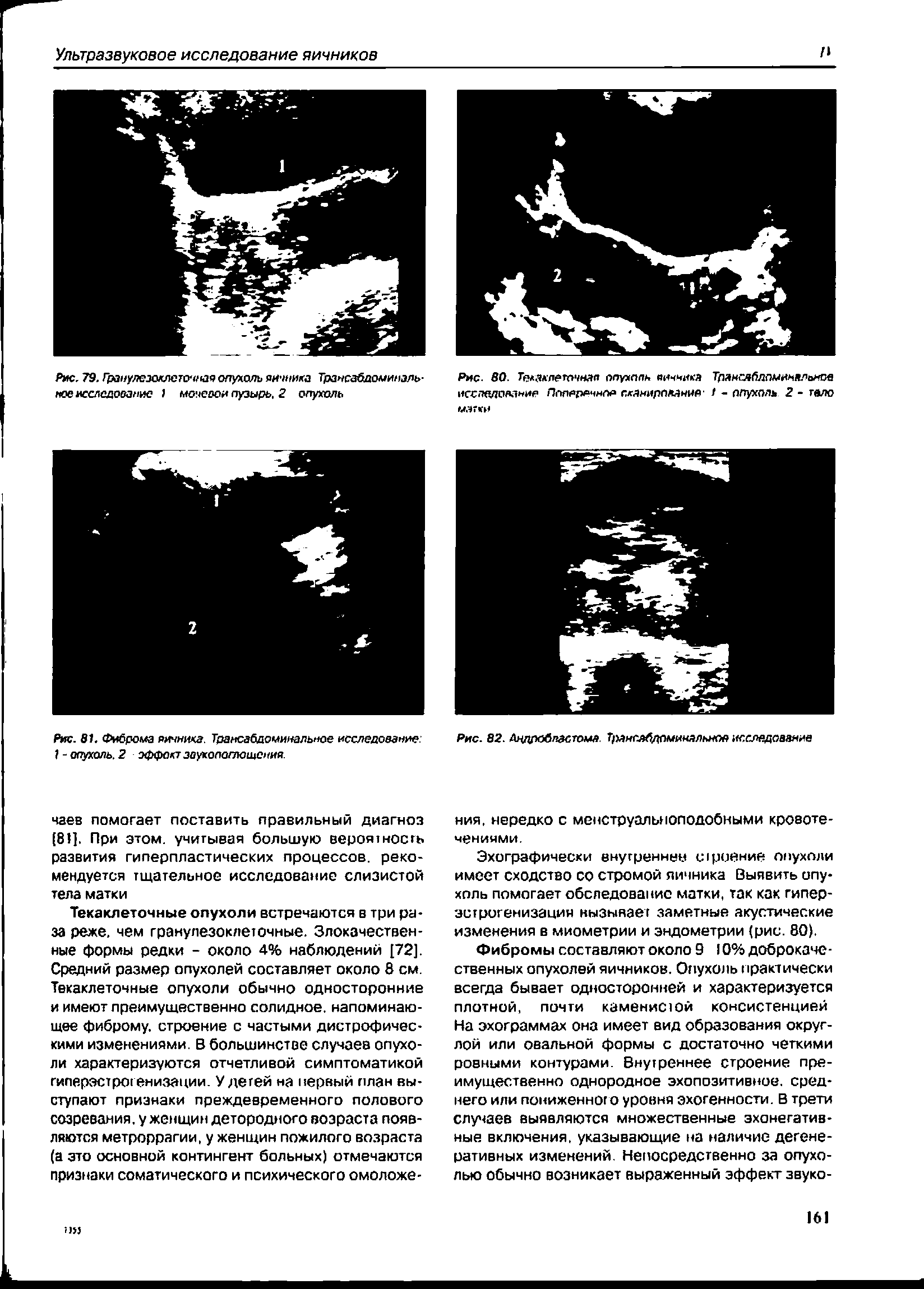 Рис. 81. Фиброма яичника. Трамсабдоминальное исследование 1- опухоль. 2 эффект звукопоглощения.