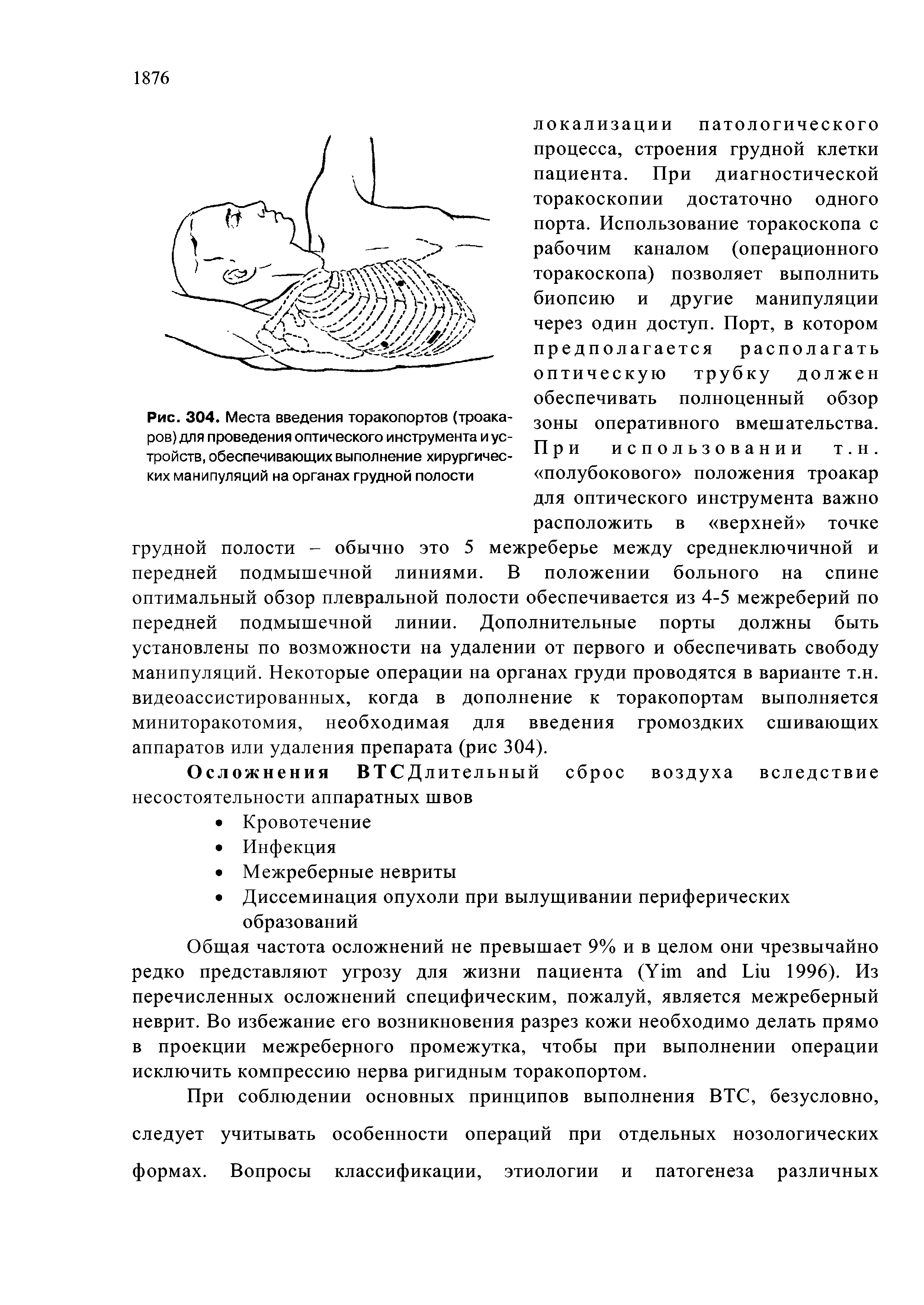 Рис. 304. Места введения торакопортов (троакаров) для проведения оптического инструмента и устройств, обеспечивающих выполнение хирургических манипуляций на органах грудной полости...