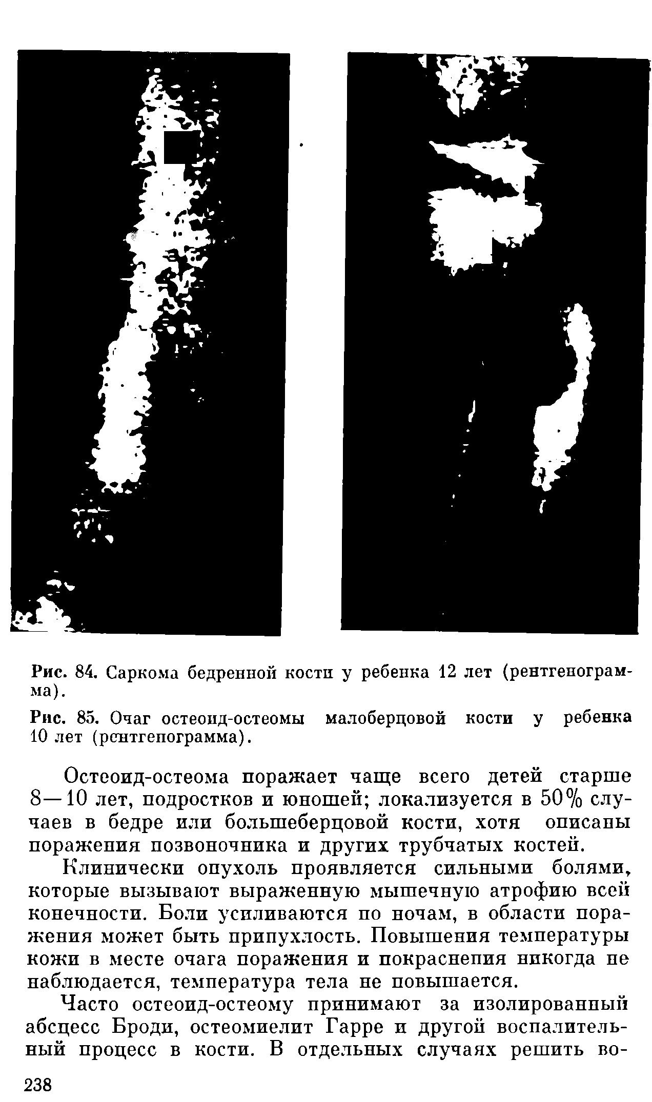 Рис. 85. Очаг остеоид-остеомы малоберцовой кости у ребенка 10 лет (рентгенограмма).