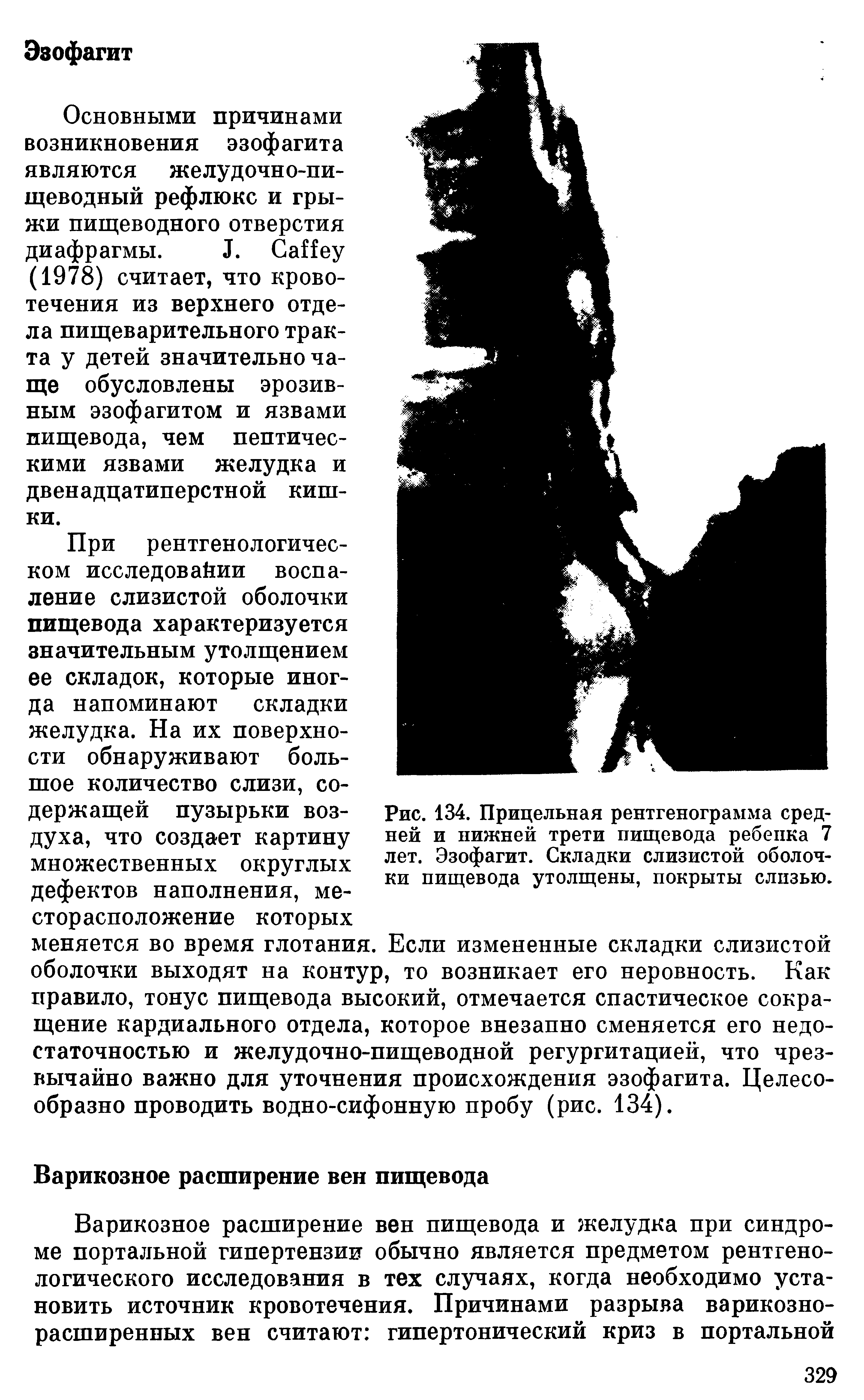 Рис. 134. Прицельная рентгенограмма средней и нижней трети пищевода ребенка 7 лет. Эзофагит. Складки слизистой оболочки пищевода утолщены, покрыты слизью.