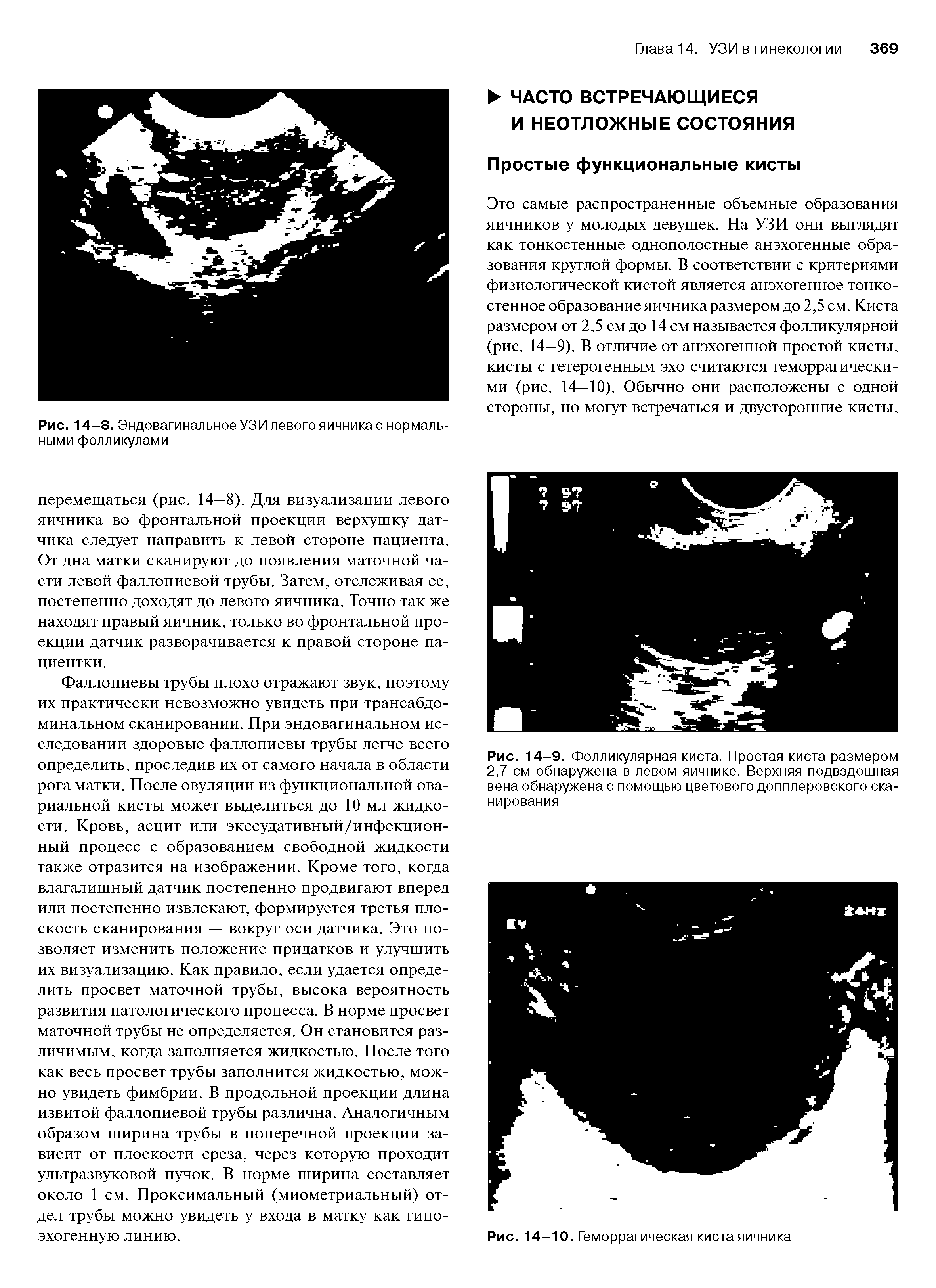 Рис. 14-9. Фолликулярная киста. Простая киста размером 2,7 см обнаружена в левом яичнике. Верхняя подвздошная вена обнаружена с помощью цветового допплеровского сканирования...