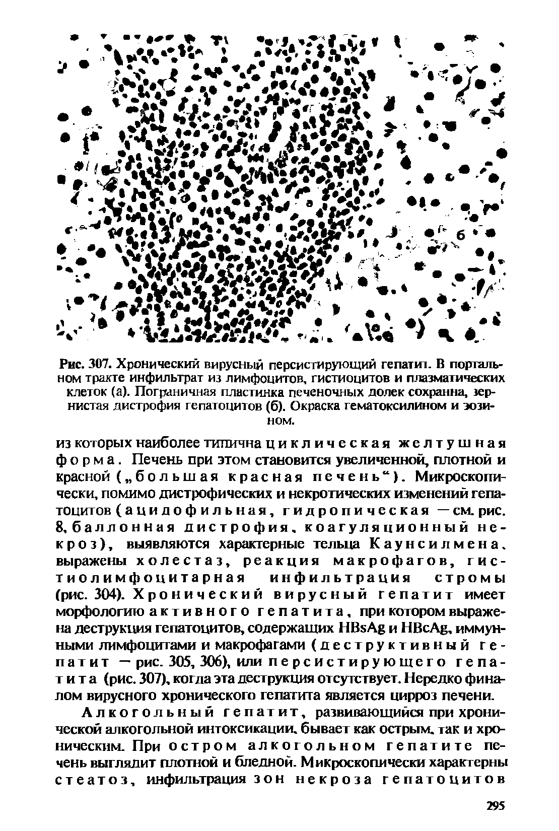 Рис. 307. Хронический вирусный персистирующий гепатит В портальном тракте инфильтрат из лимфоцитов, гистиоцитов и плазматических клеток (а). Пограничная пластинка печеночных долек сохранна, зернистая дистрофия гепатоцитов (б). Окраска гематоксилином и эозином.