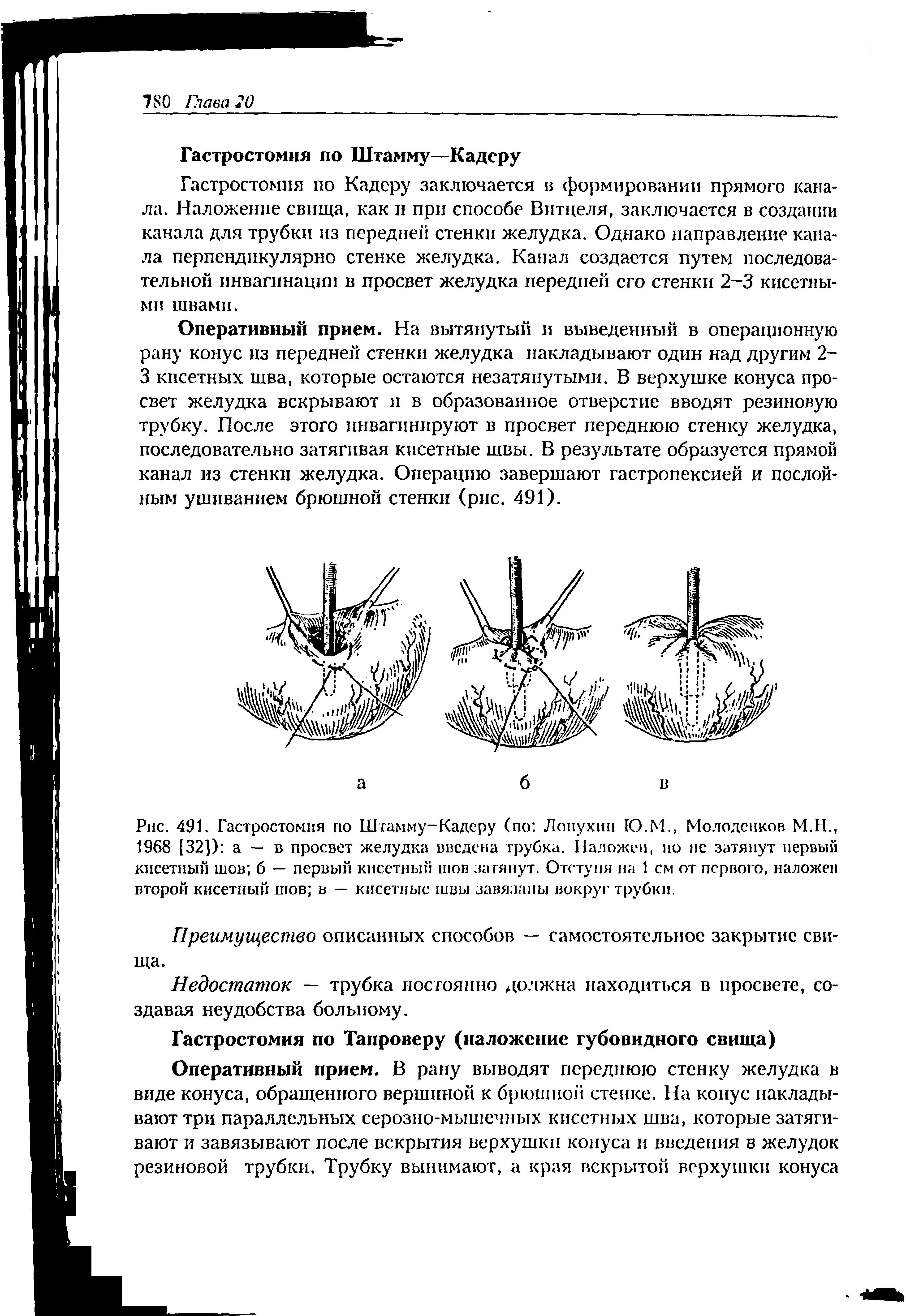 Рис. 491. Гастростомия по Штамму-Кадеру (по Лопухин Ю.М., Молодснков М.Н., 1968 [32]) а — в просвет желудка введена трубка. Наложен, но нс затянут первый кисетный шов б — первый кисетный шов затянут. Отступя на 1 см от первого, наложен второй кисетный шов в — кисетные швы завязаны вокруг трубки.