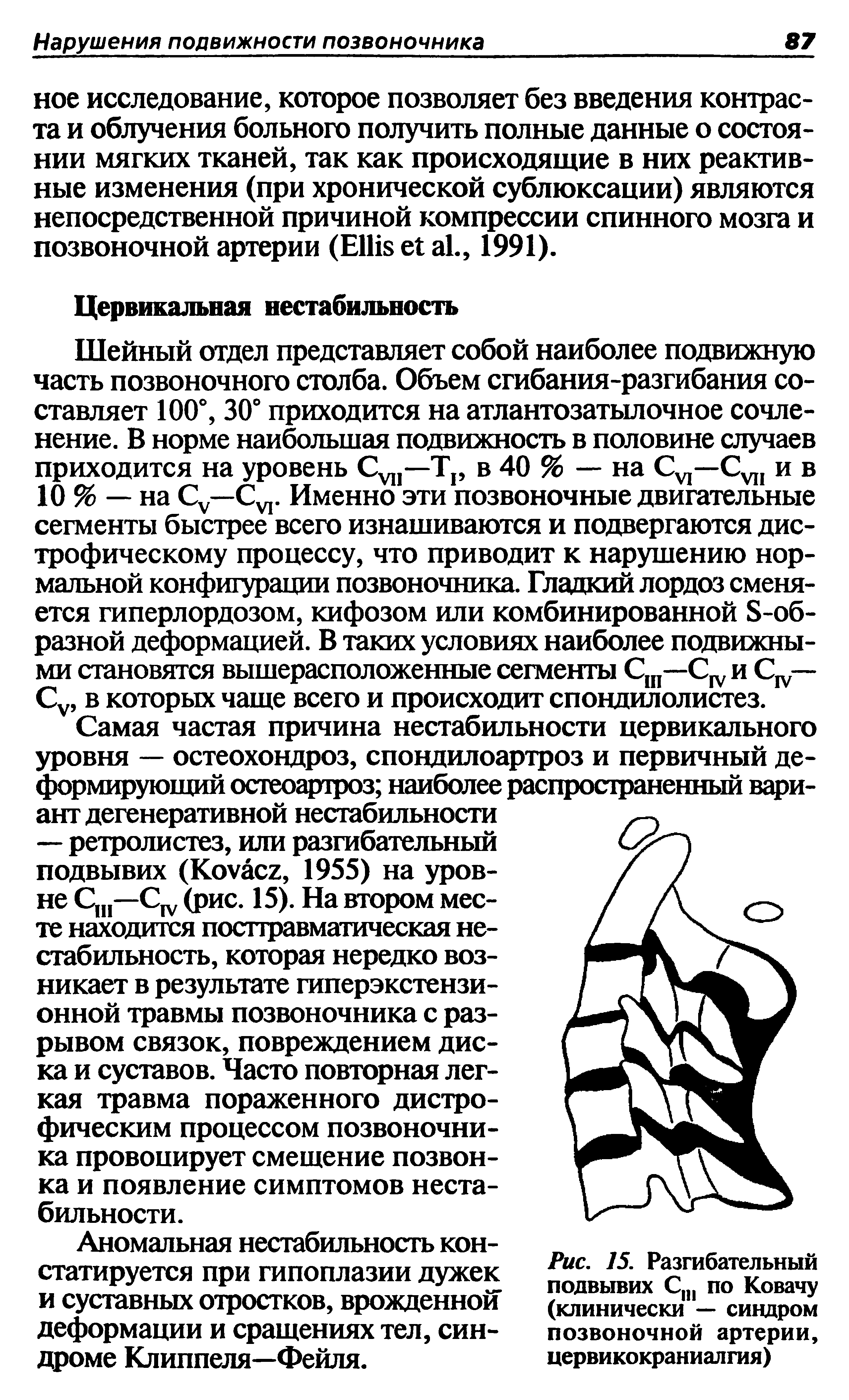 Рис. 15. Разгибательный подвывих Ст по Ковачу (клинически — синдром позвоночной артерии, цервикокраниалгия)...