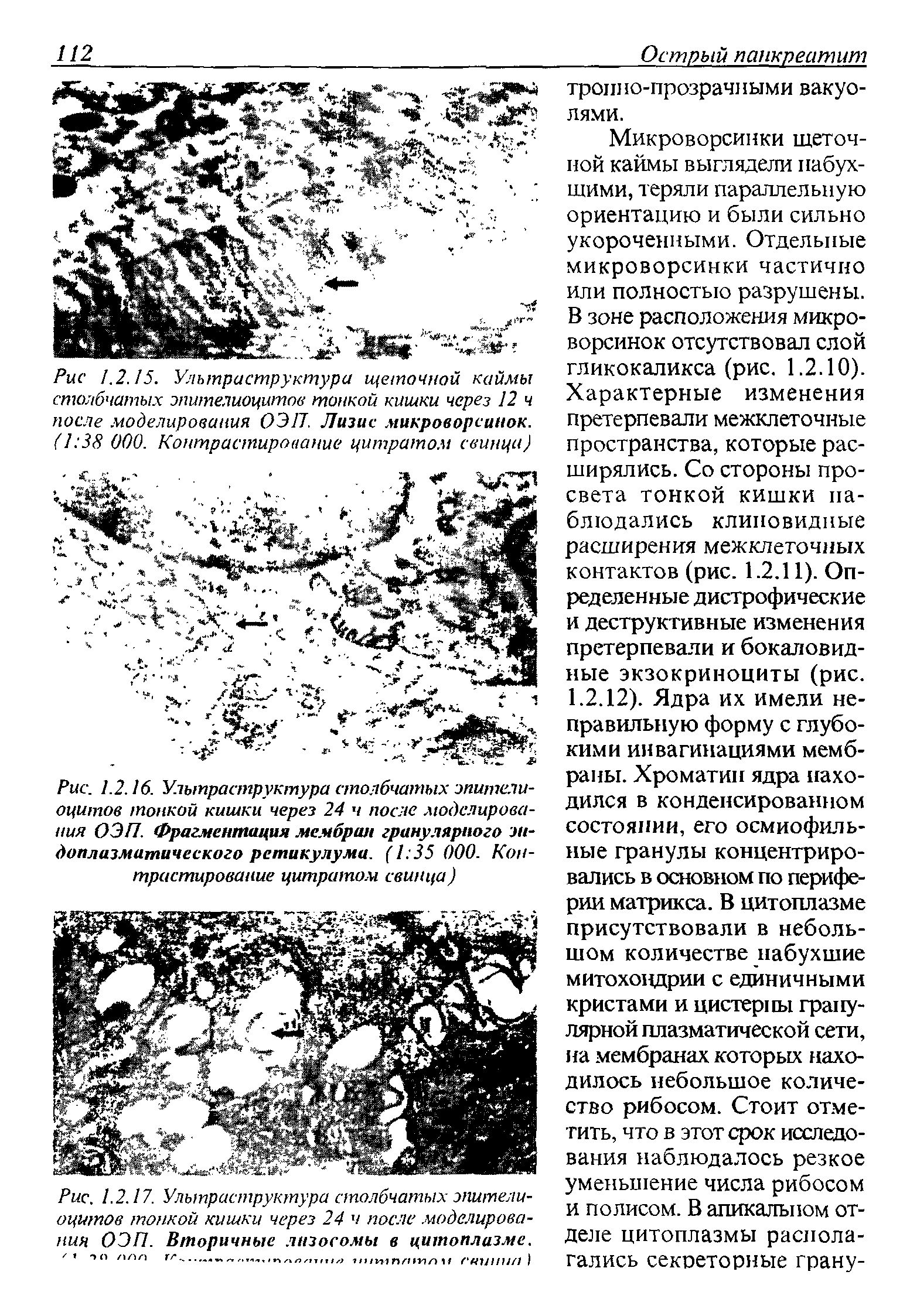 Рис. 1.2.17. Ультраструктура столбчатых эпителиоцитов тонкой кишки через 24 ч после моделирования ОЭП. Вторичные лизосомы в цитоплазме. то ппп ТГ.-питплтлк гтнив)...