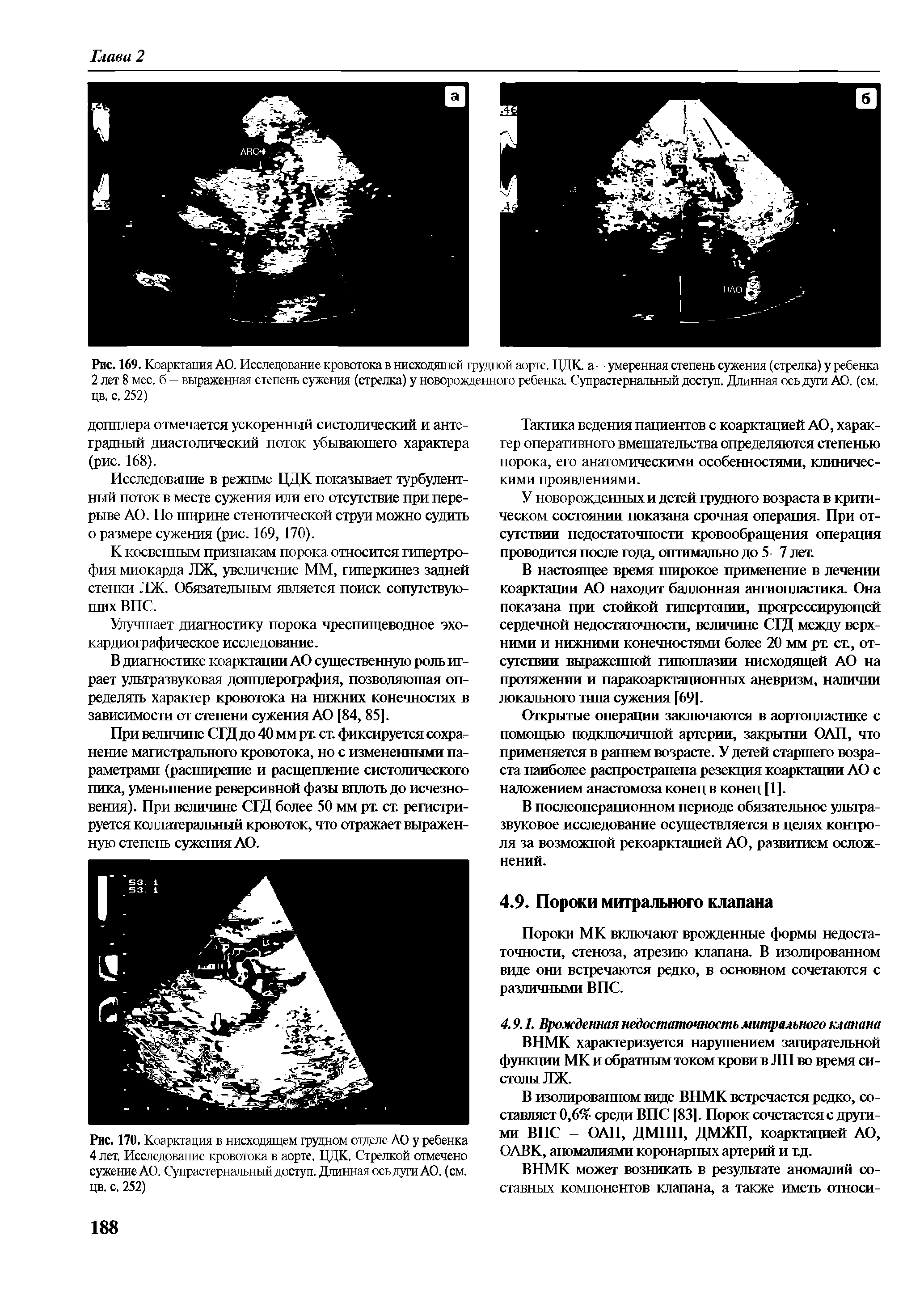 Рис. 170. Коарктация в нисходящем грудном отделе АО у ребенка 4 лет. Исследование кровотока в аорте. ЦДК. Стрелкой отмечено сужение АО. Супрастернальный доступ. Длинная освдуги АО. (см. цв. с. 252)...