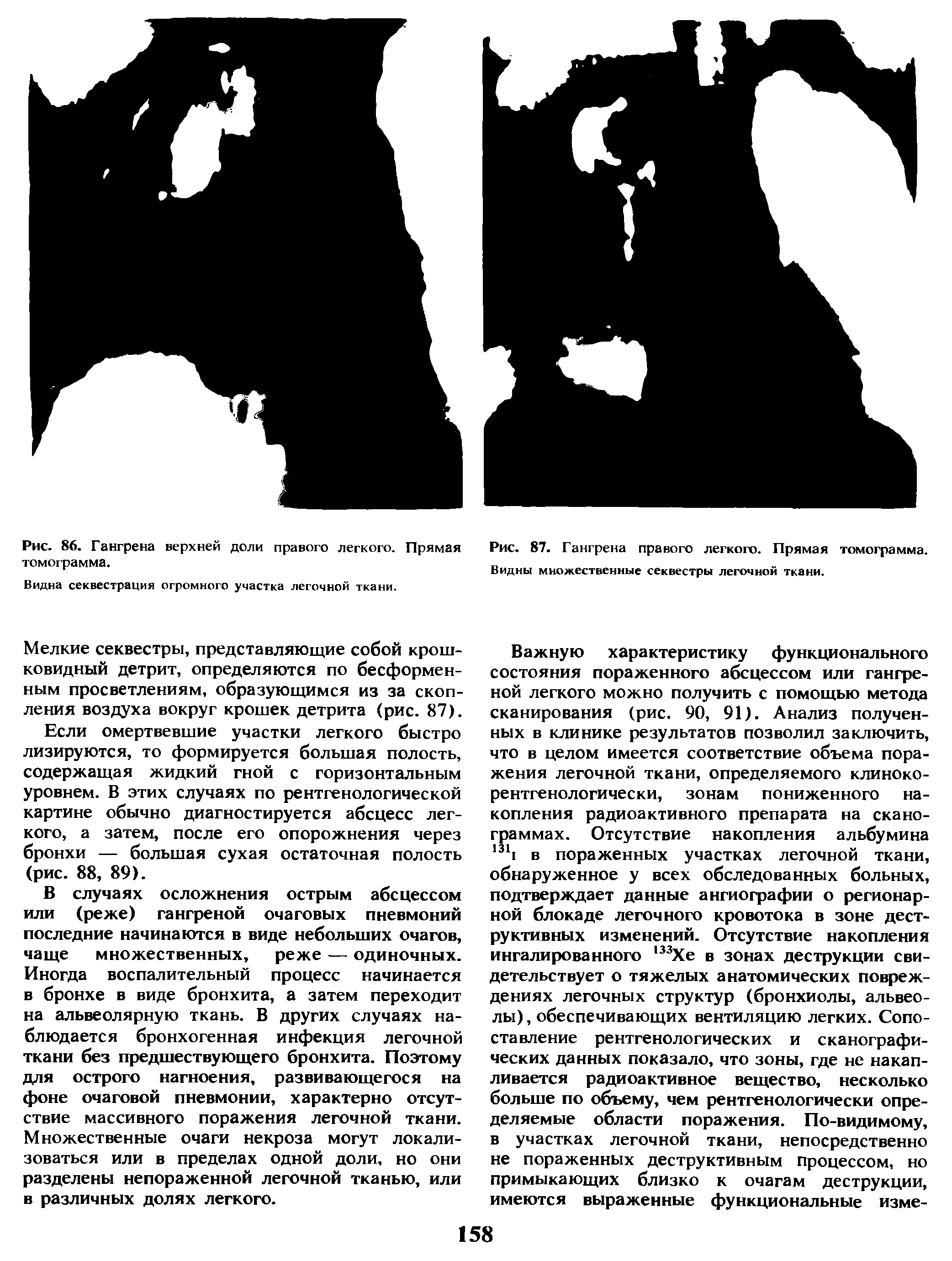 Рис. 87. Гангрена правого легкого. Прямая томограмма. Видны множественные секвестры легочной ткани.