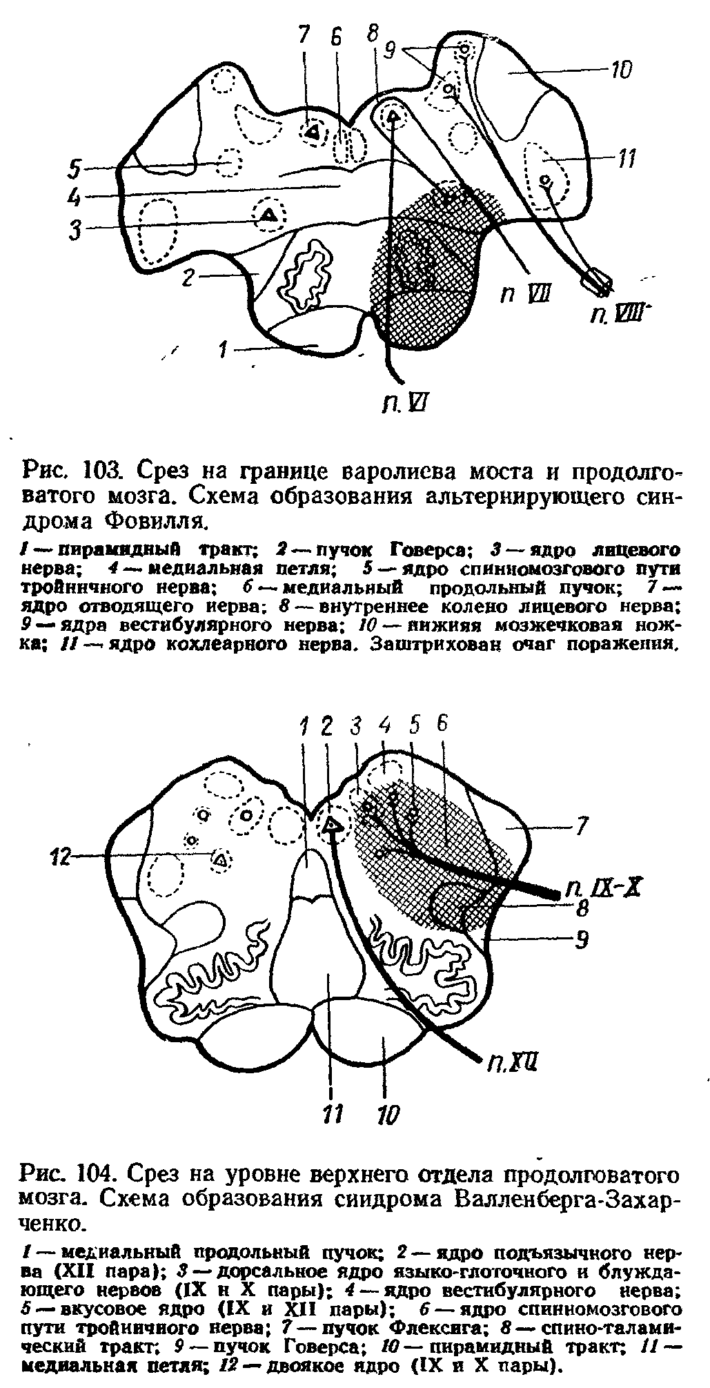 Рис. 103. Срез на границе варолиева моста и продолговатого мозга. Схема образования альтернирующего синдрома Фовилля.