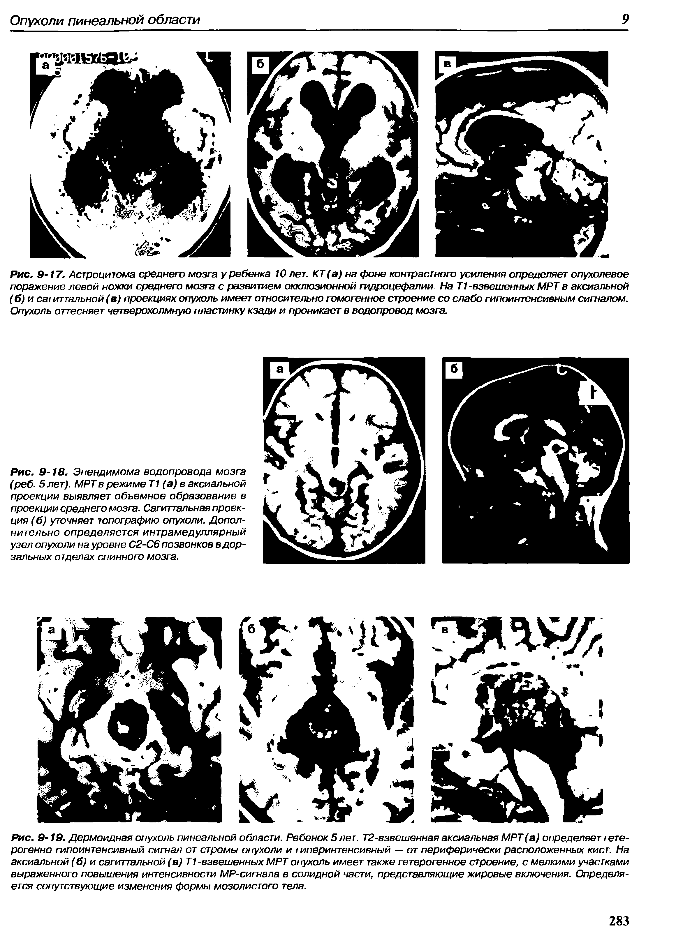 Рис. 9-18. Эпендимома водопровода мозга (реб. 5 лет). МРТ в режиме Т1 (а) в аксиальной проекции выявляет объемное образование в проекции среднего мозга. Сагиттальная проекция (б) уточняет топографию опухоли. Дополнительно определяется интрамедуллярный узел опухоли на уровне С2-С6 позвонков в дорзальных отделах спинного мозга.