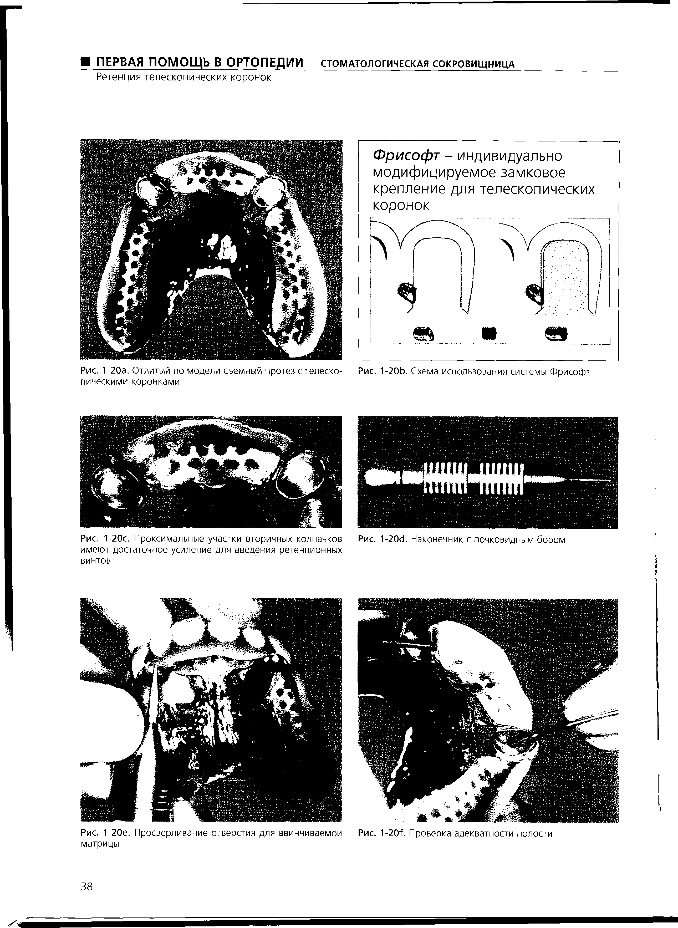 Рис. 1-20с. Проксимальные участки вторичных колпачков имеют достаточное усиление для введения ретенционных винтов...