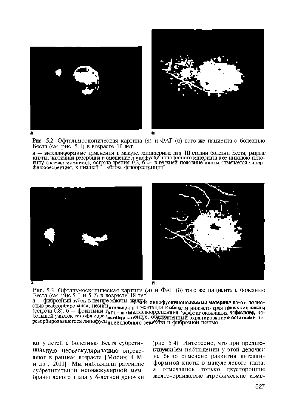 Рис. 5.2. Офтальмоскопическая картина ( и ФАГ (б) того же пациента с болезнью Беста (см рис 5 I в возрасте 10 лет.