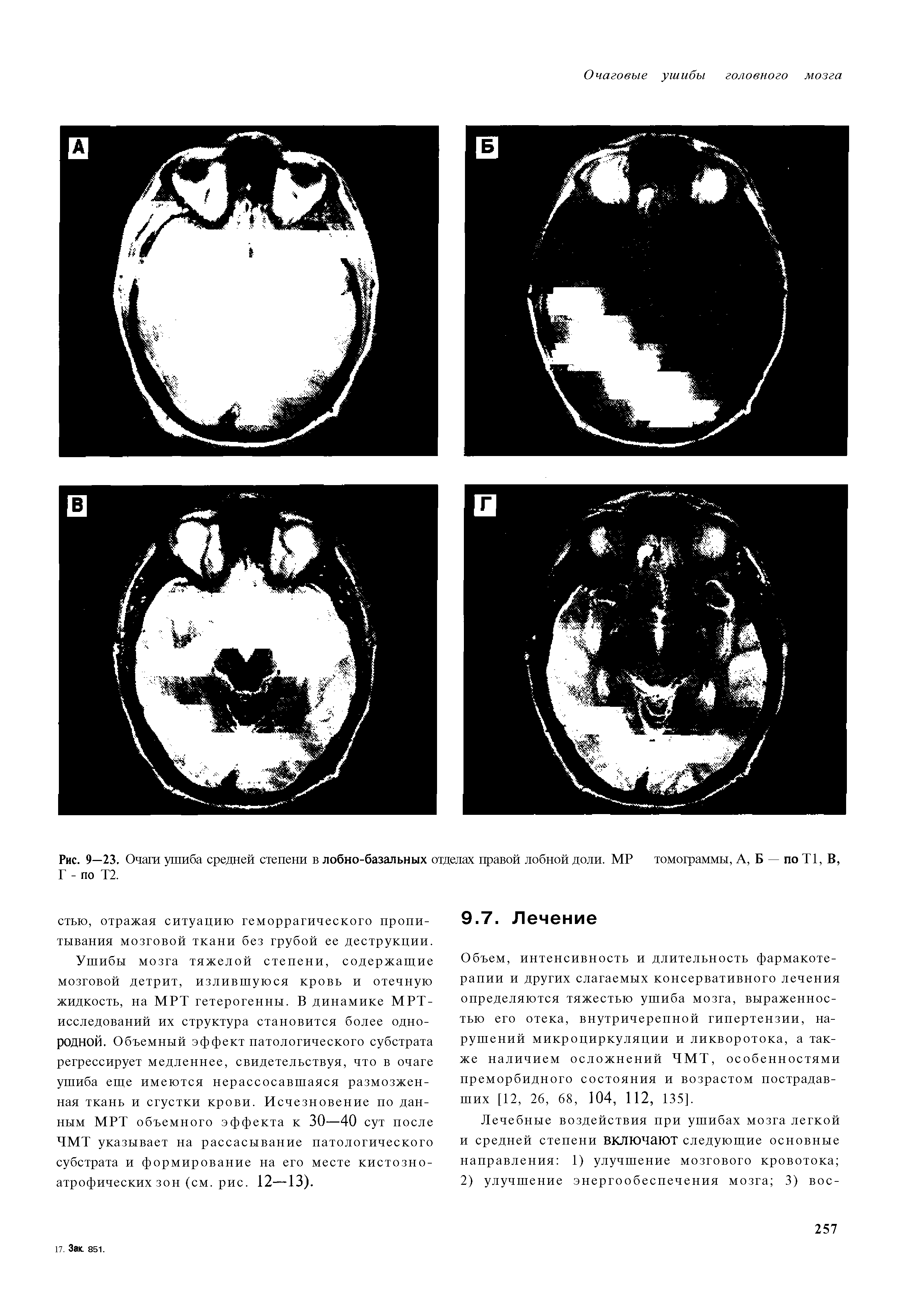 Рис. 9—23. Очаги ушиба средней степени в лобно-базальных отделах правой лобной доли. МР томограммы, А, Б по Т1, В, Г - по Т2.