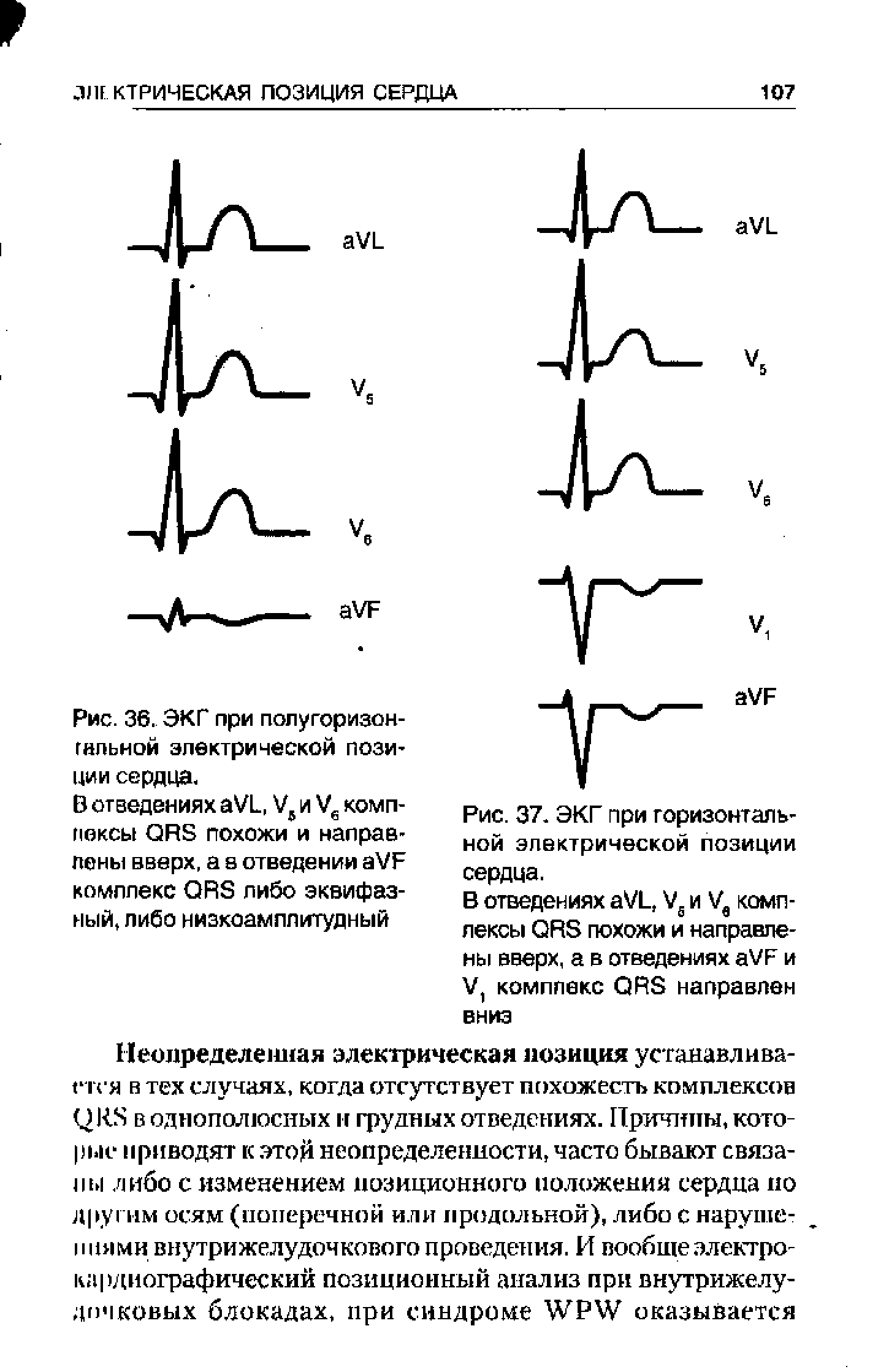 Рис. 36. ЭКГ при пол угор ИЗОН-ГИЛЬ ной электрической позиции сердца.