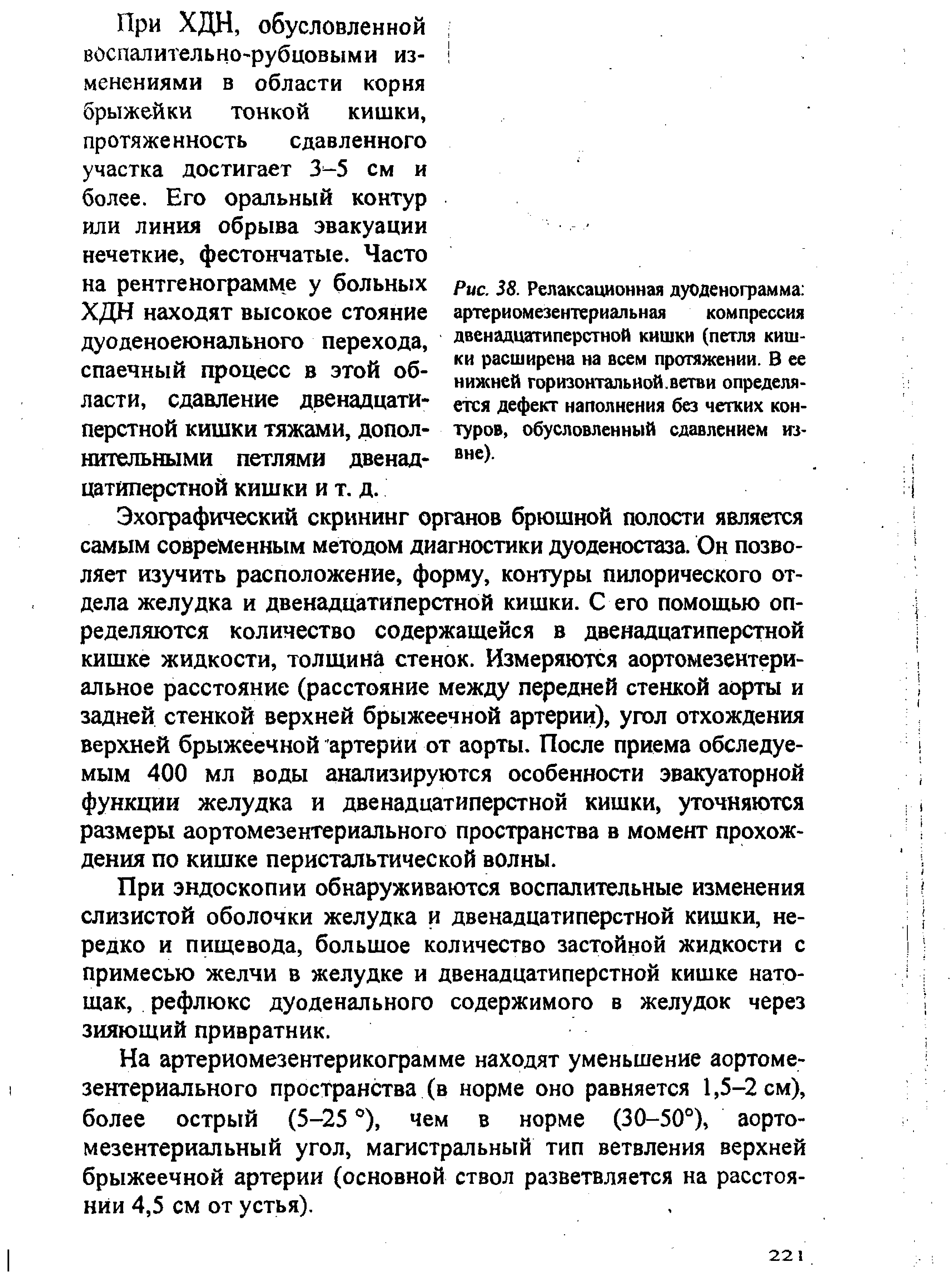 Рис. 38. Релаксационная дуоденограмма артери омезентериальная компрессия двенадцатиперстной кишки (петля кишки расширена на всем протяжении. В ее нижней горизонталь ной. ветви определяется дефект наполнения без четких контуров, обусловленный сдавлением извне).