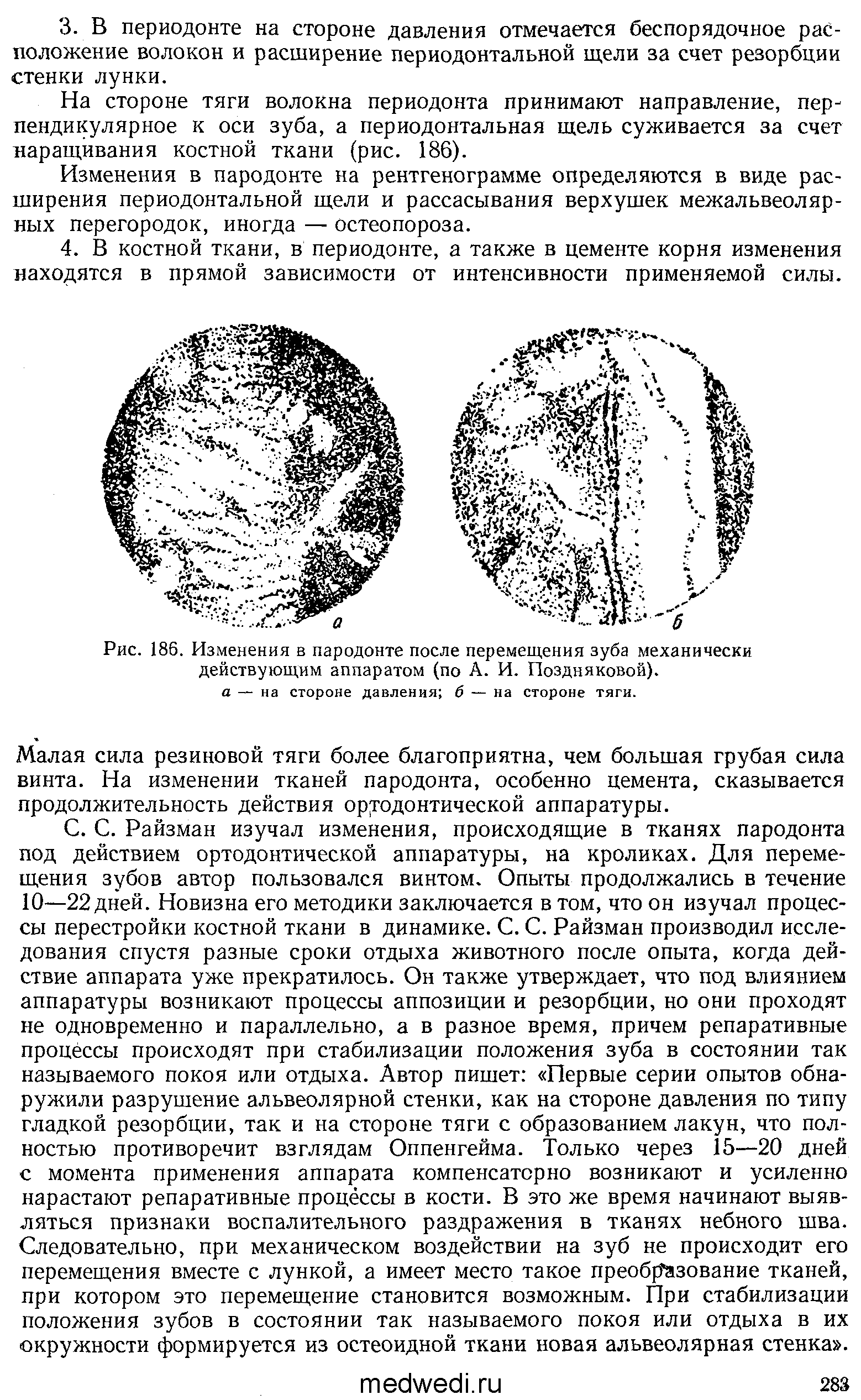 Рис. 186. Изменения в пародонте после перемещения зуба механически действующим аппаратом (по А. И. Поздняковой). а — на стороне давления б — на стороне тяги.