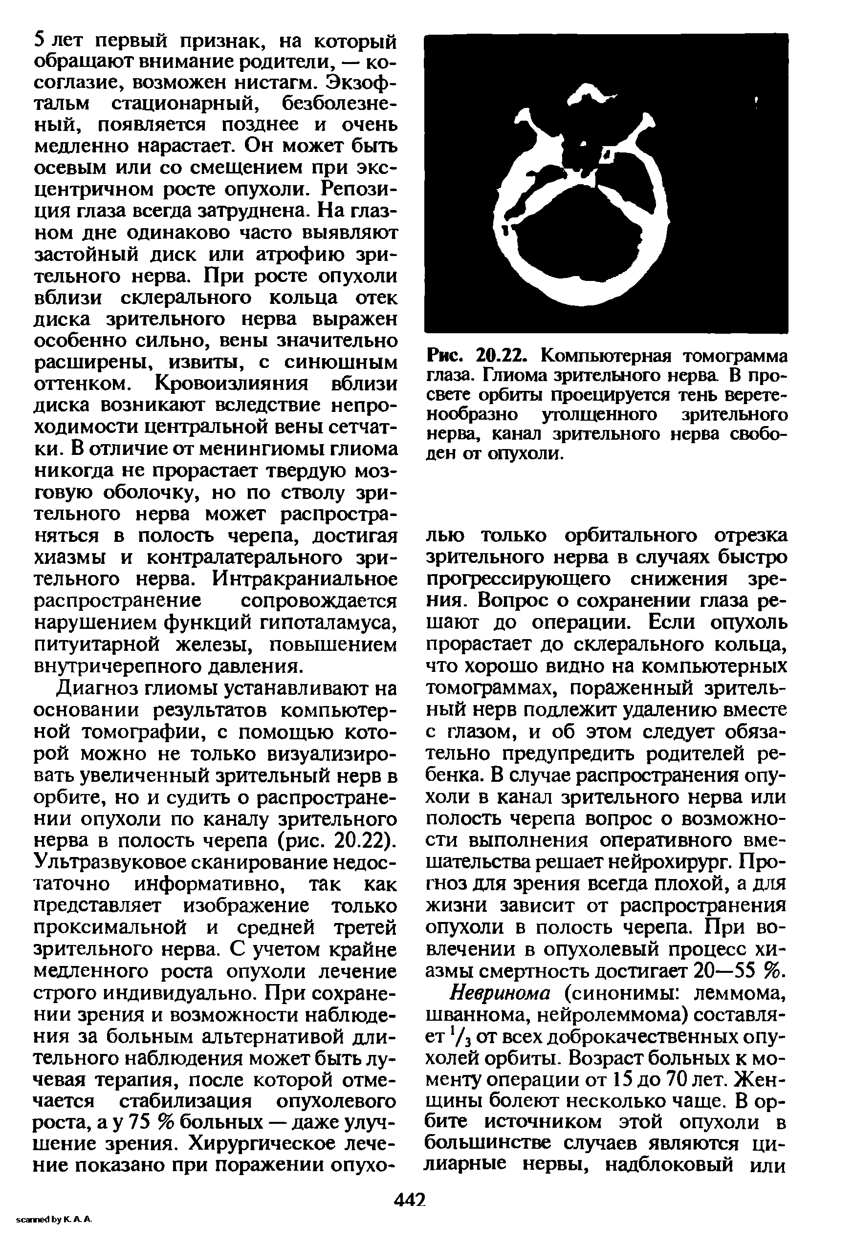 Рис. 20.22. Компьютерная томограмма глаза. Глиома зрительного нерва В просвете орбиты проецируется тень веретенообразно утолщенного зрительного нерва, канал зрительного нерва свободен от опухоли.