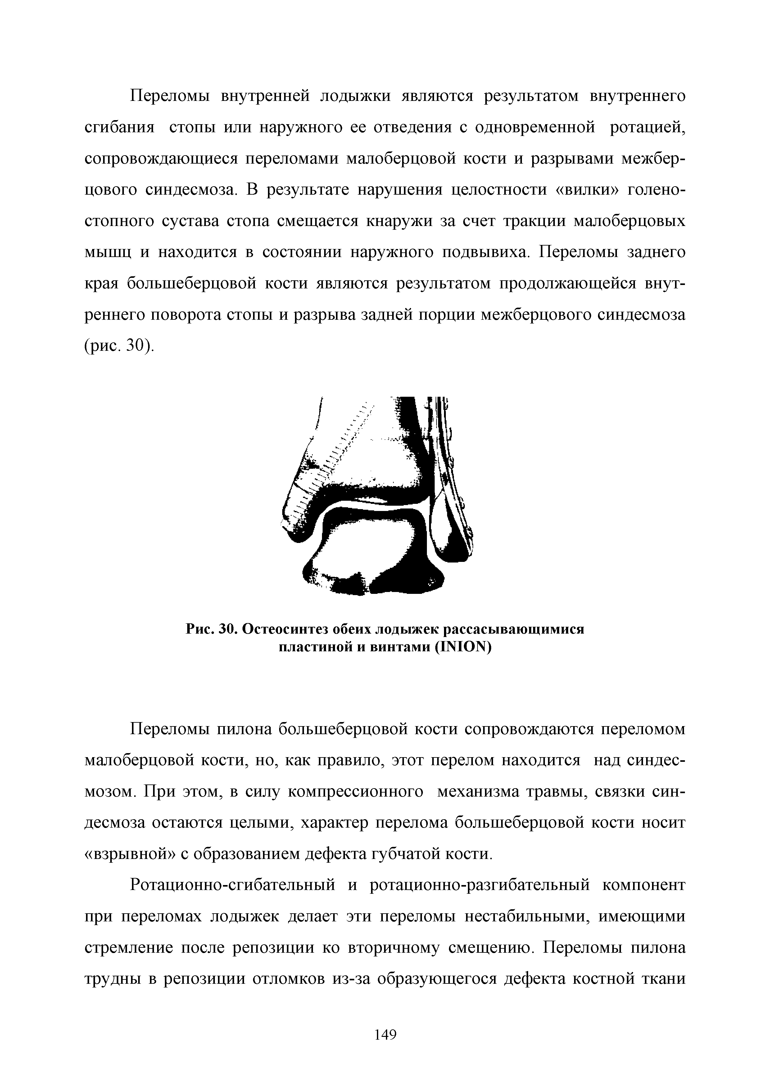 Рис. 30. Остеосинтез обеих лодыжек рассасывающимися пластиной и винтами (INION)...