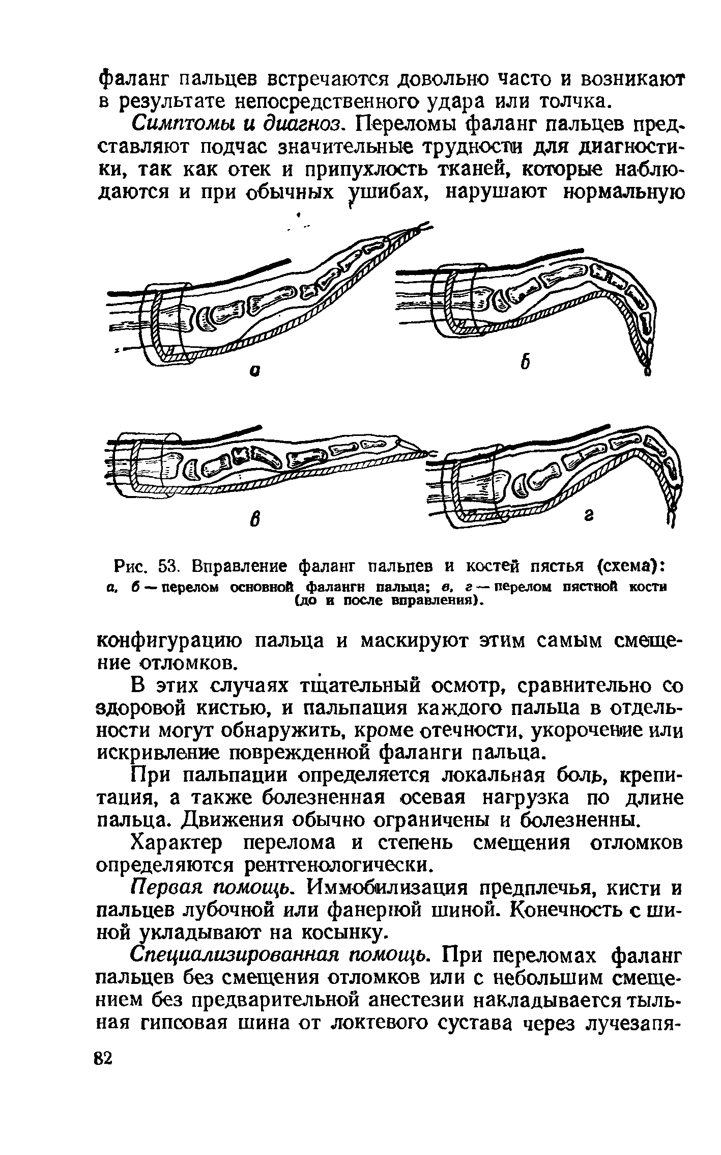 Рис. 53. Вправление фаланг пальпев и костей пястья (схема) а б — перелом основной фаланги пальца в, г — перелом пястной кости (до и после вправления).