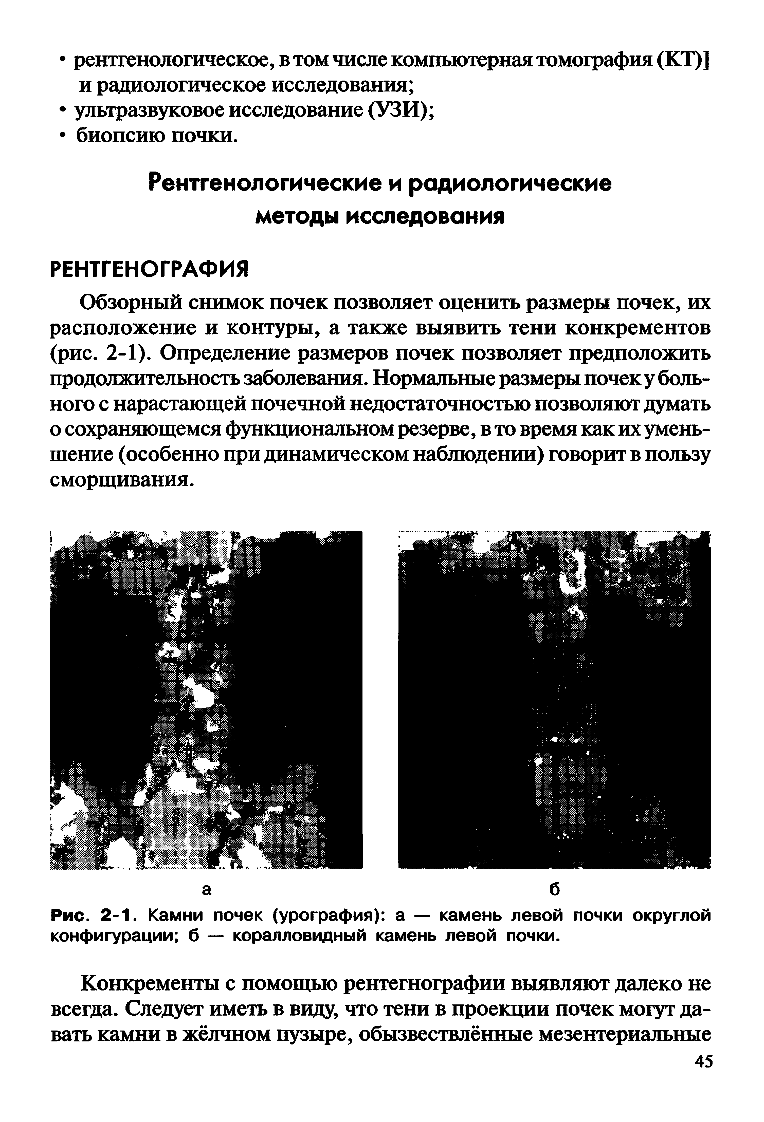 Рис. 2-1. Камни почек (урография) а — камень левой почки округлой конфигурации б — коралловидный камень левой почки.