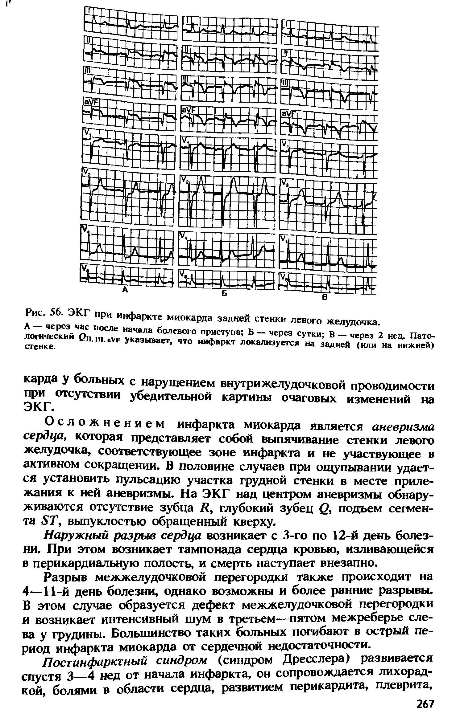 Рис. 56. ЭКГ при инфаркте миокарда задней стенки левого желудочка. л< чески3йЧО. ПОСЛе Иа4ала болевого приступа Б - через сутки В - через 2 нед. Патостенке. Указывает, что инфаркт локализуется на задней (или на нижней)...